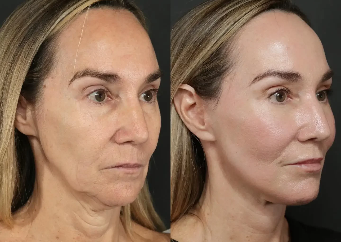 Face Lift Surgery Pictures Before After