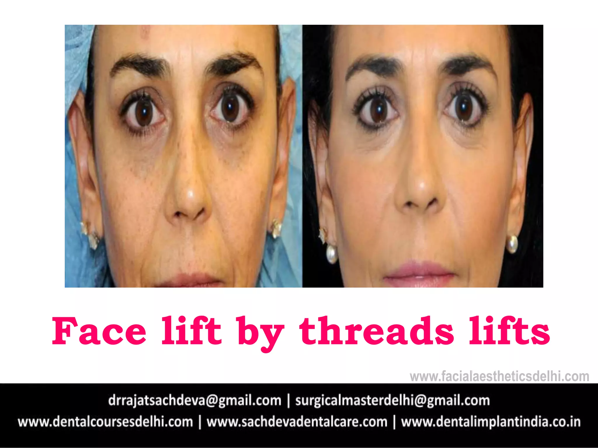 Face Lift Without Surgery