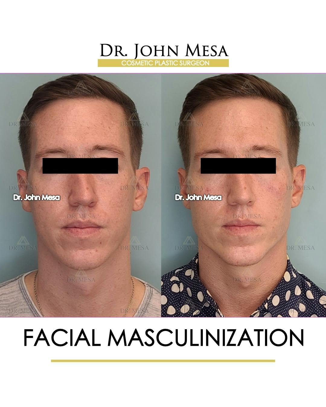 Face Masculinization Surgery