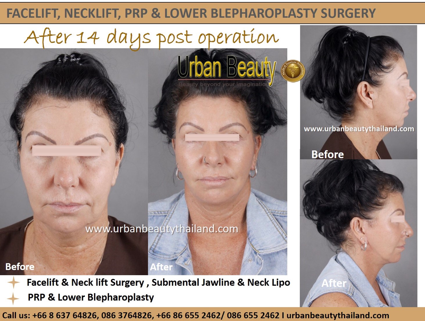 Face Surgery Cost In Thailand