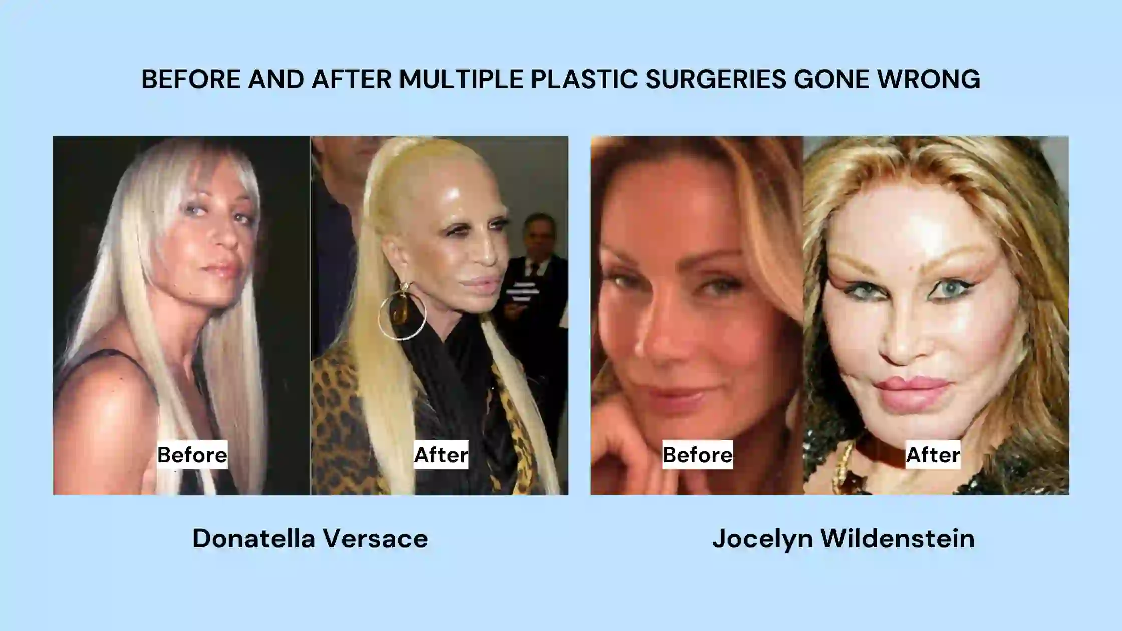 Face Surgery Gone Wrong Images