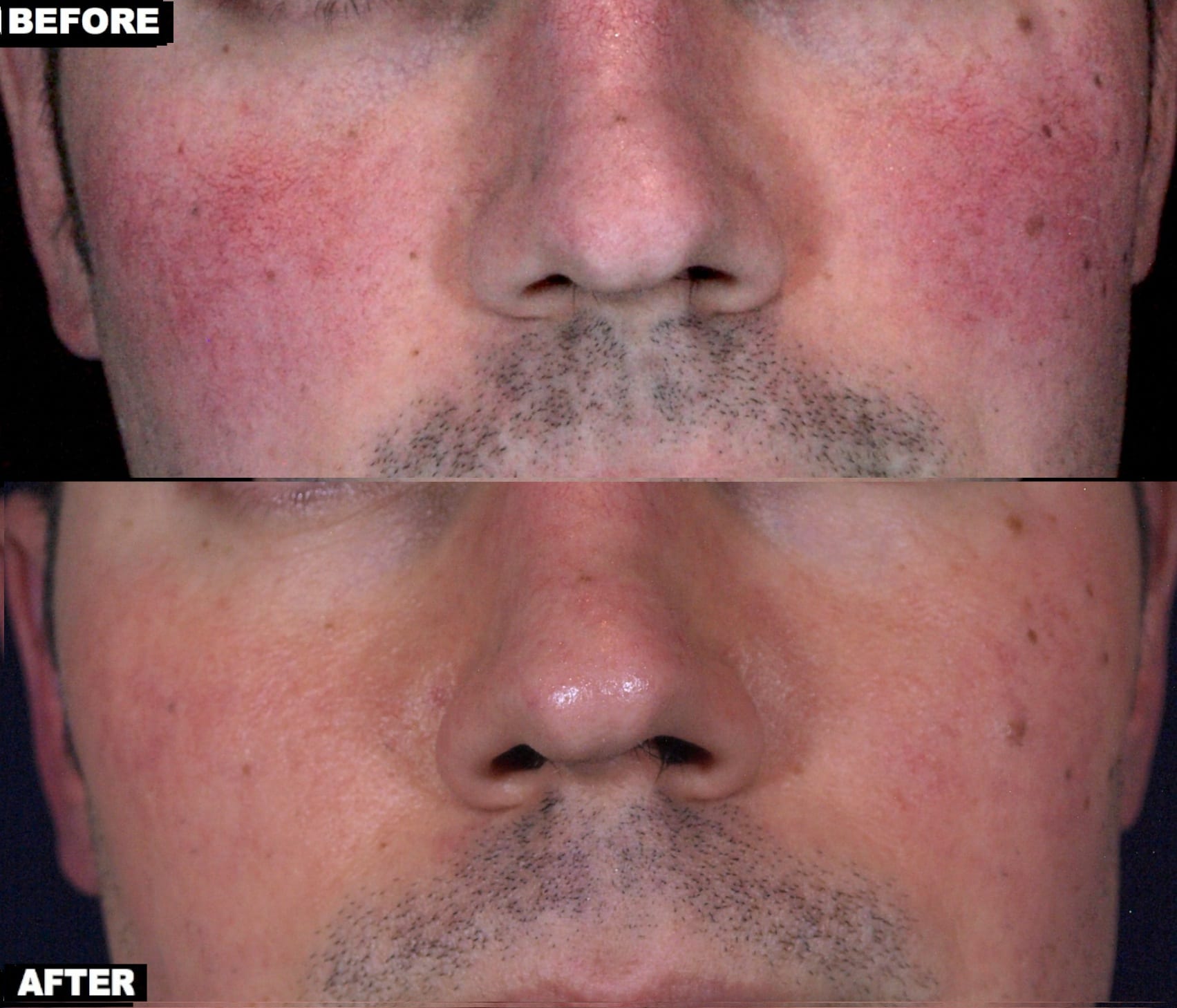 Facial Redness Flushing