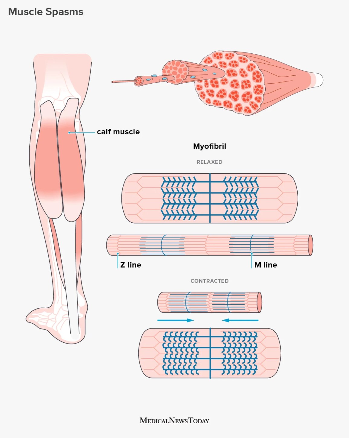 Fasciculations Muscle Twitching