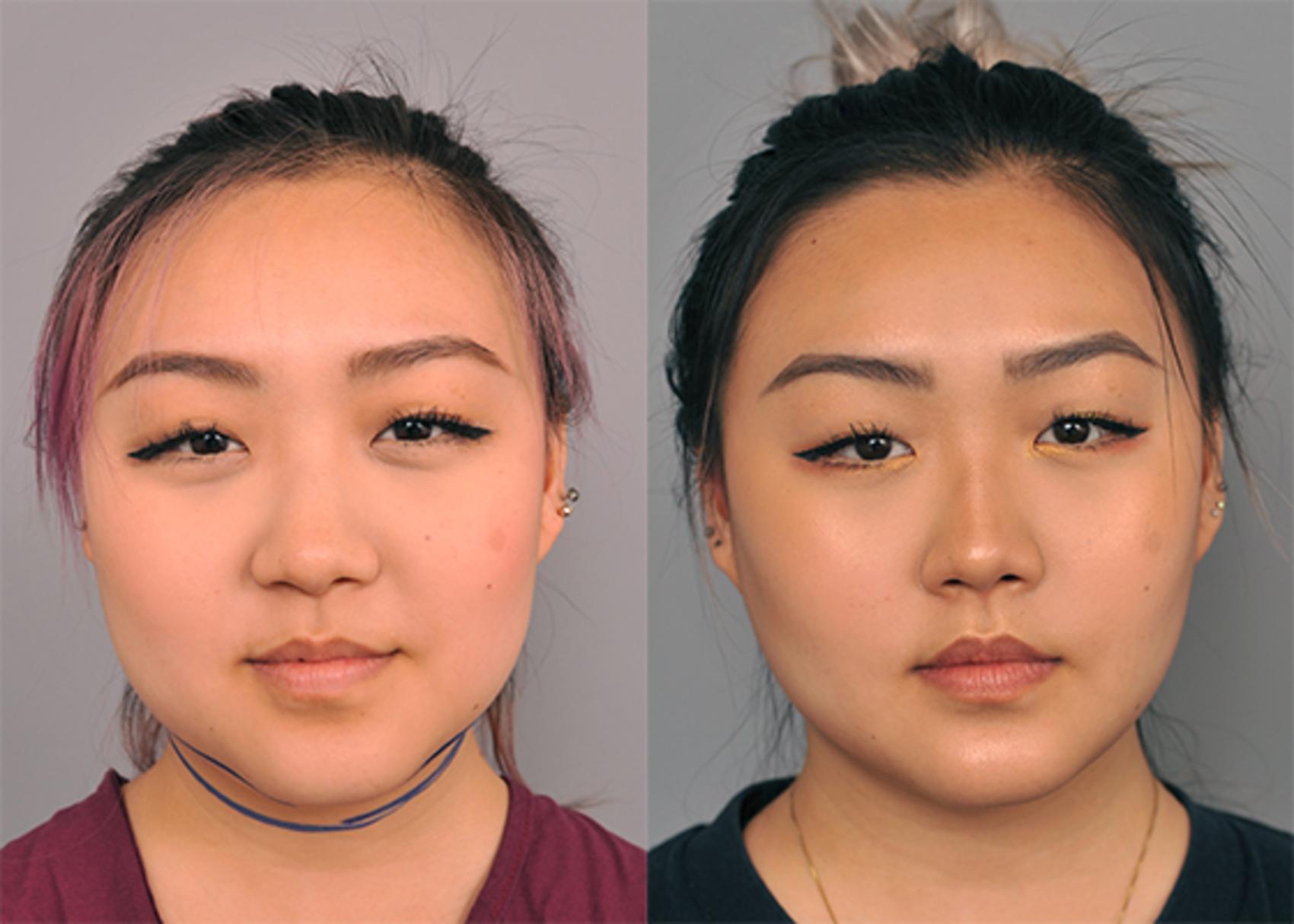 Fat In Face Surgery
