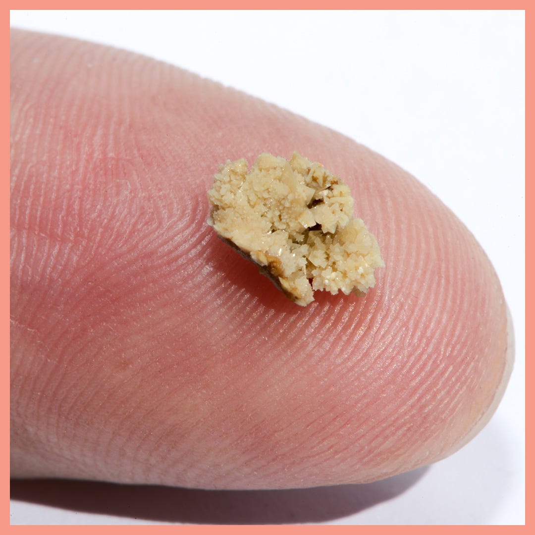 Female Kidney Stones In Toilet