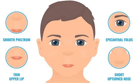 Fetal Alcohol Syndrome Eyes