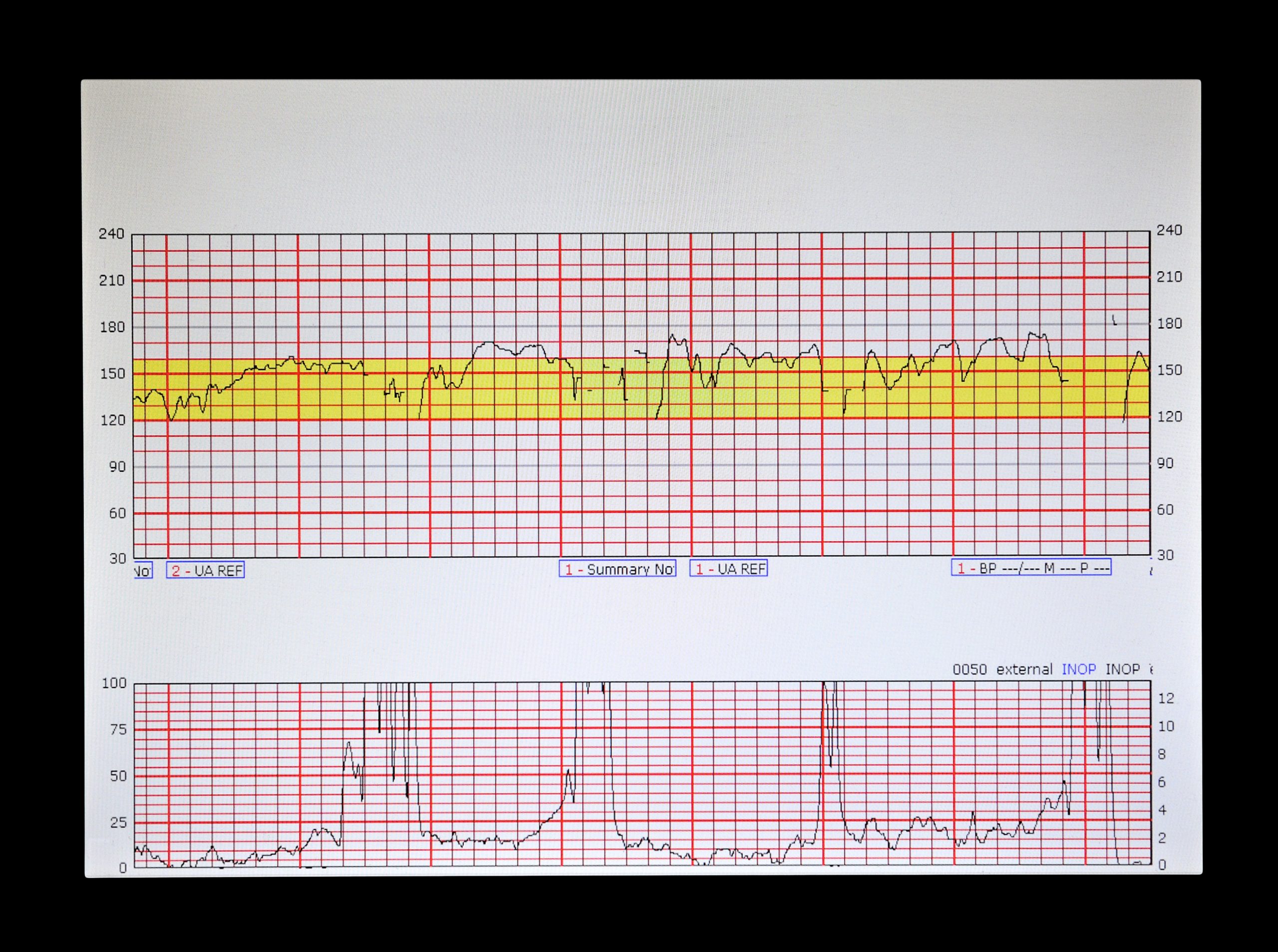 Fetal Heart Tracing