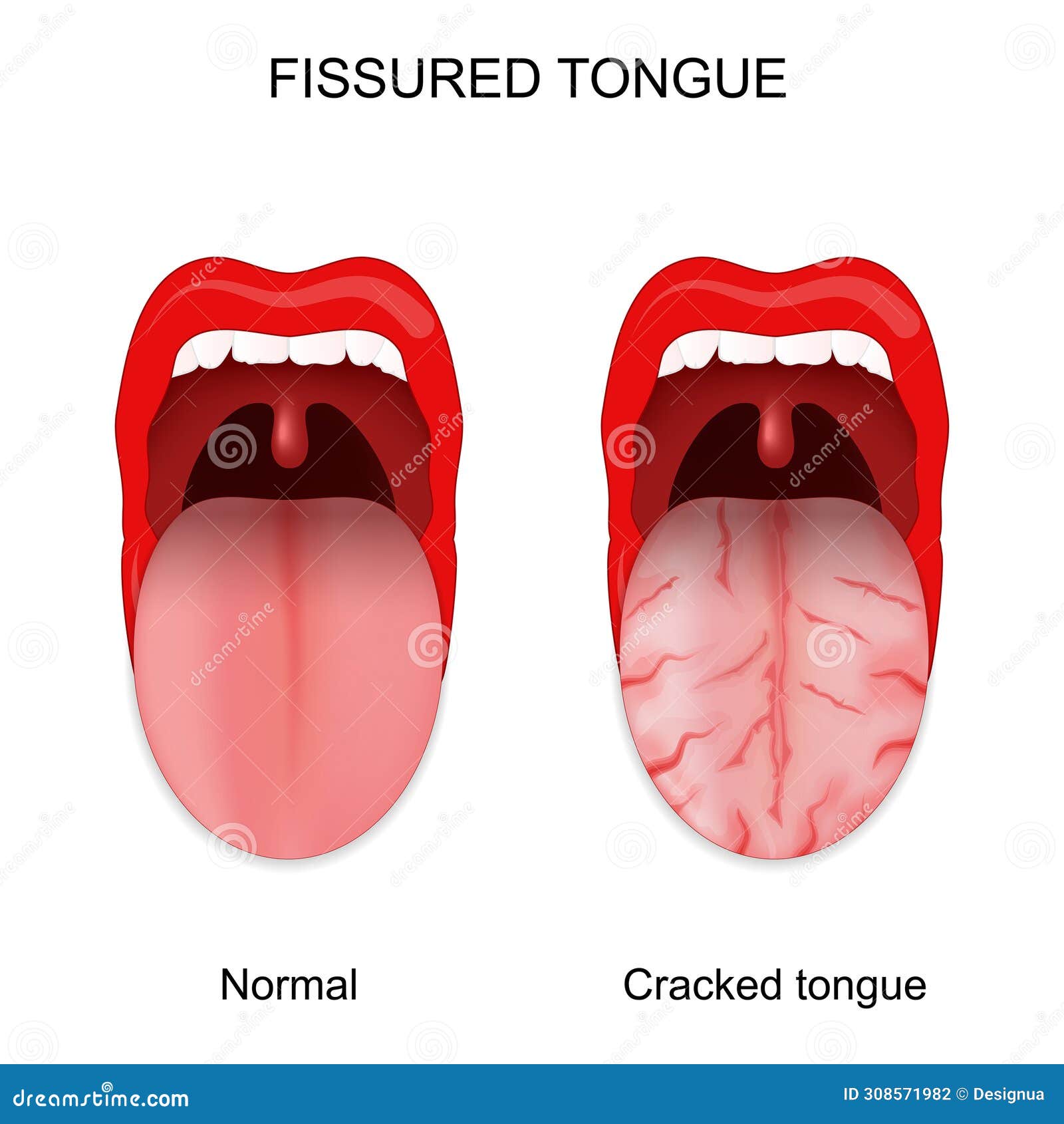 Fissured Cracked Tongue