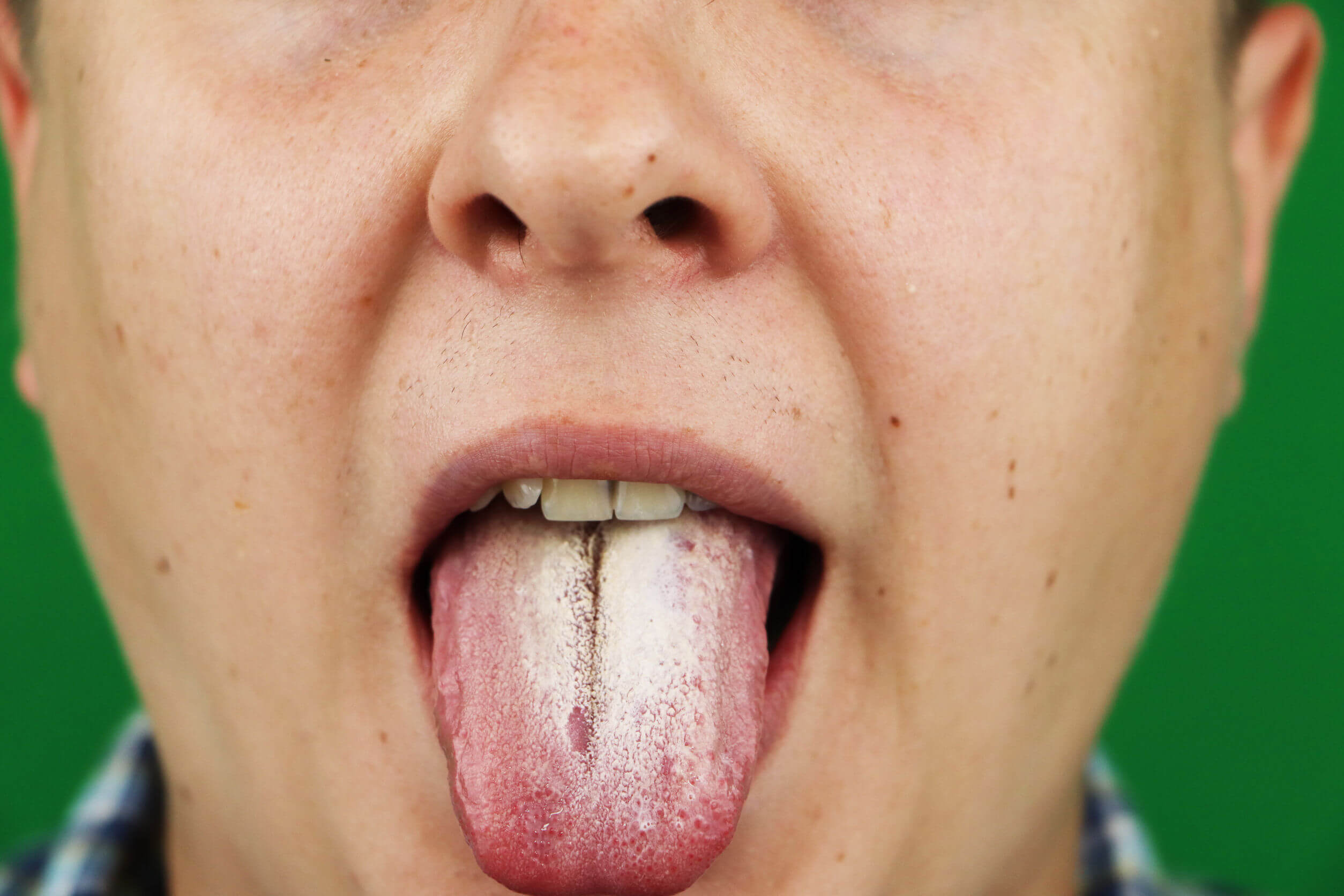 Fissured Tongue Causes