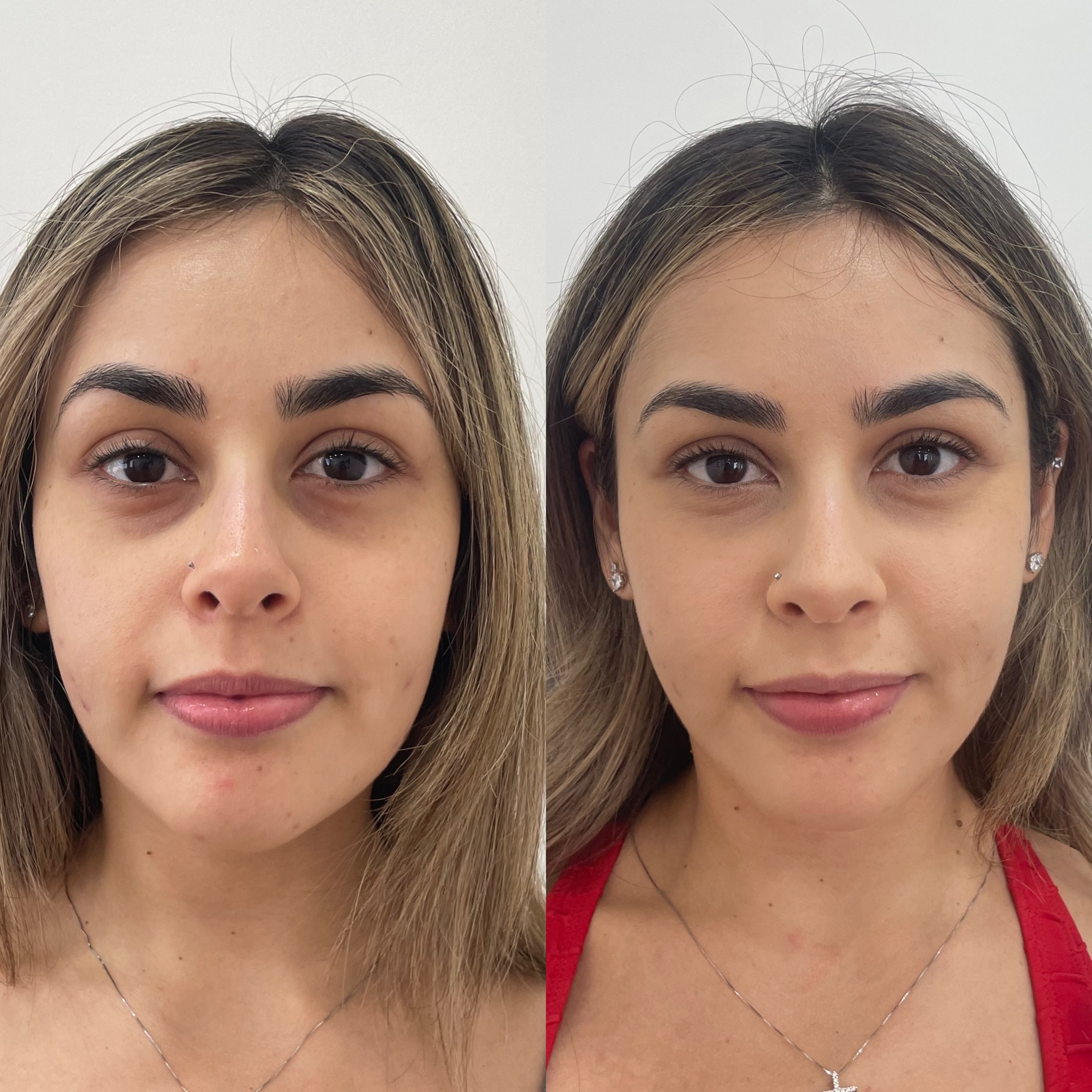 Fix Tired Face Without Surgery
