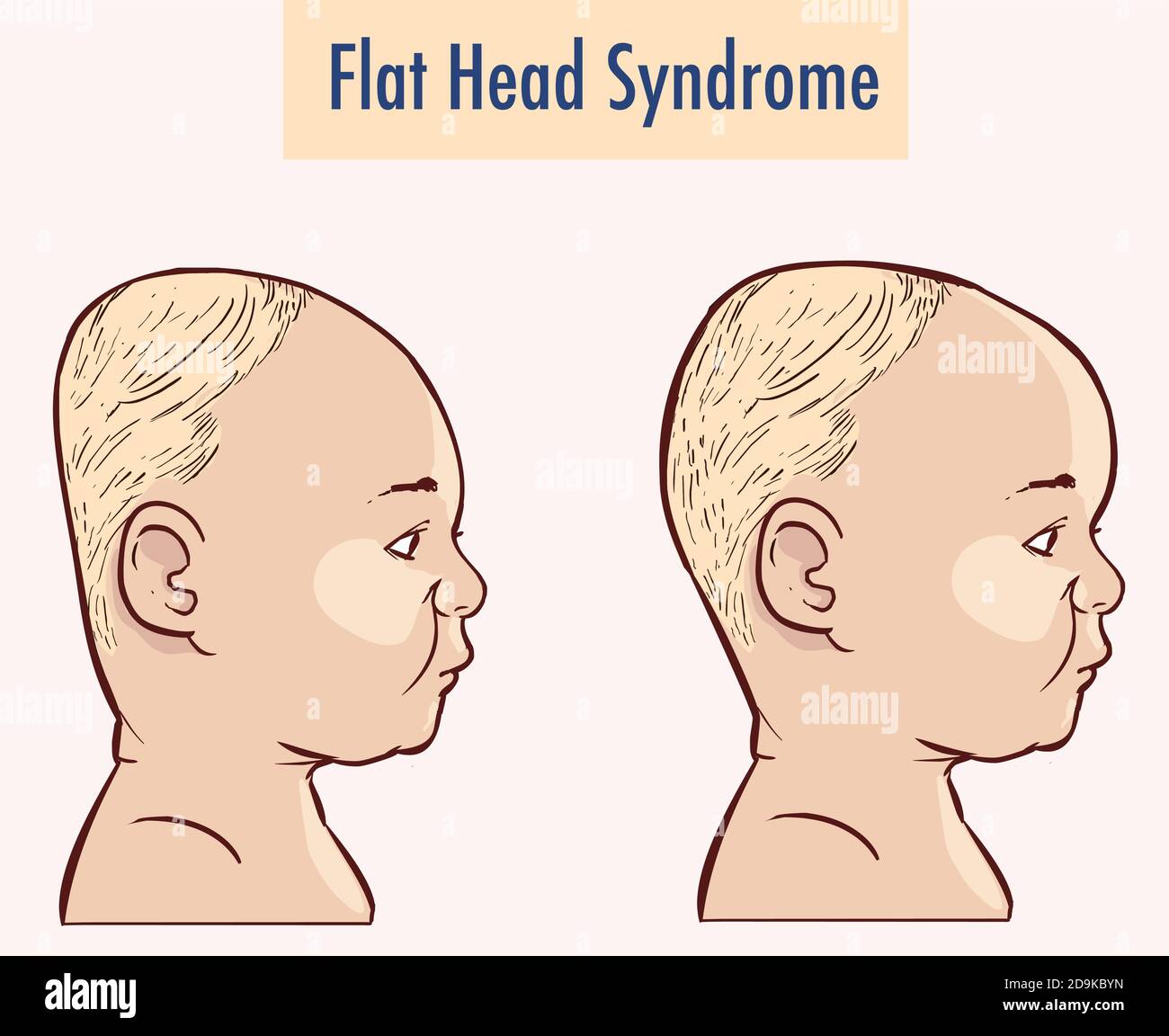 Flat Head Syndrome