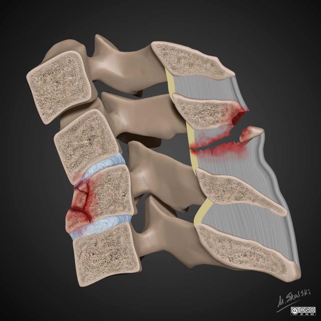 Flexion Teardrop Fracture