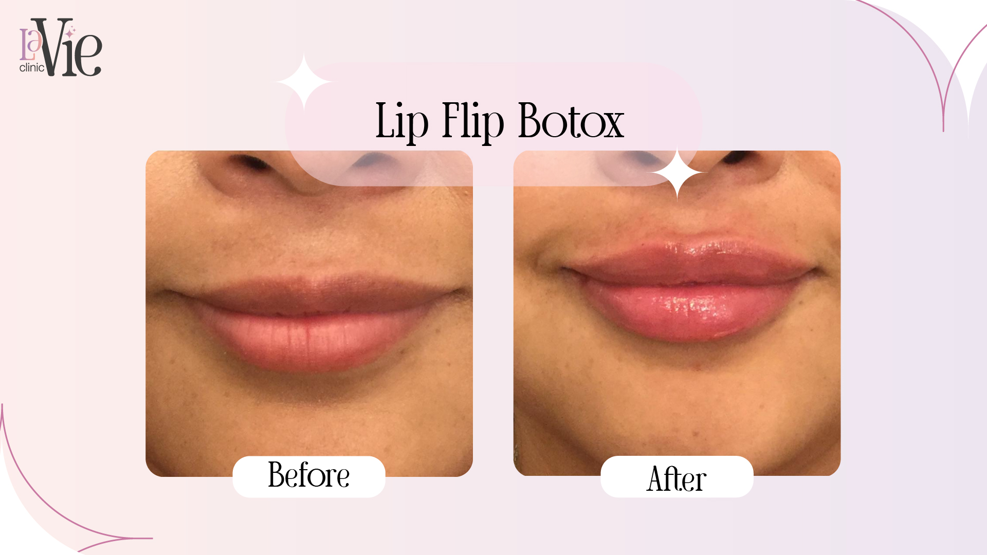 Flip Lip Botox