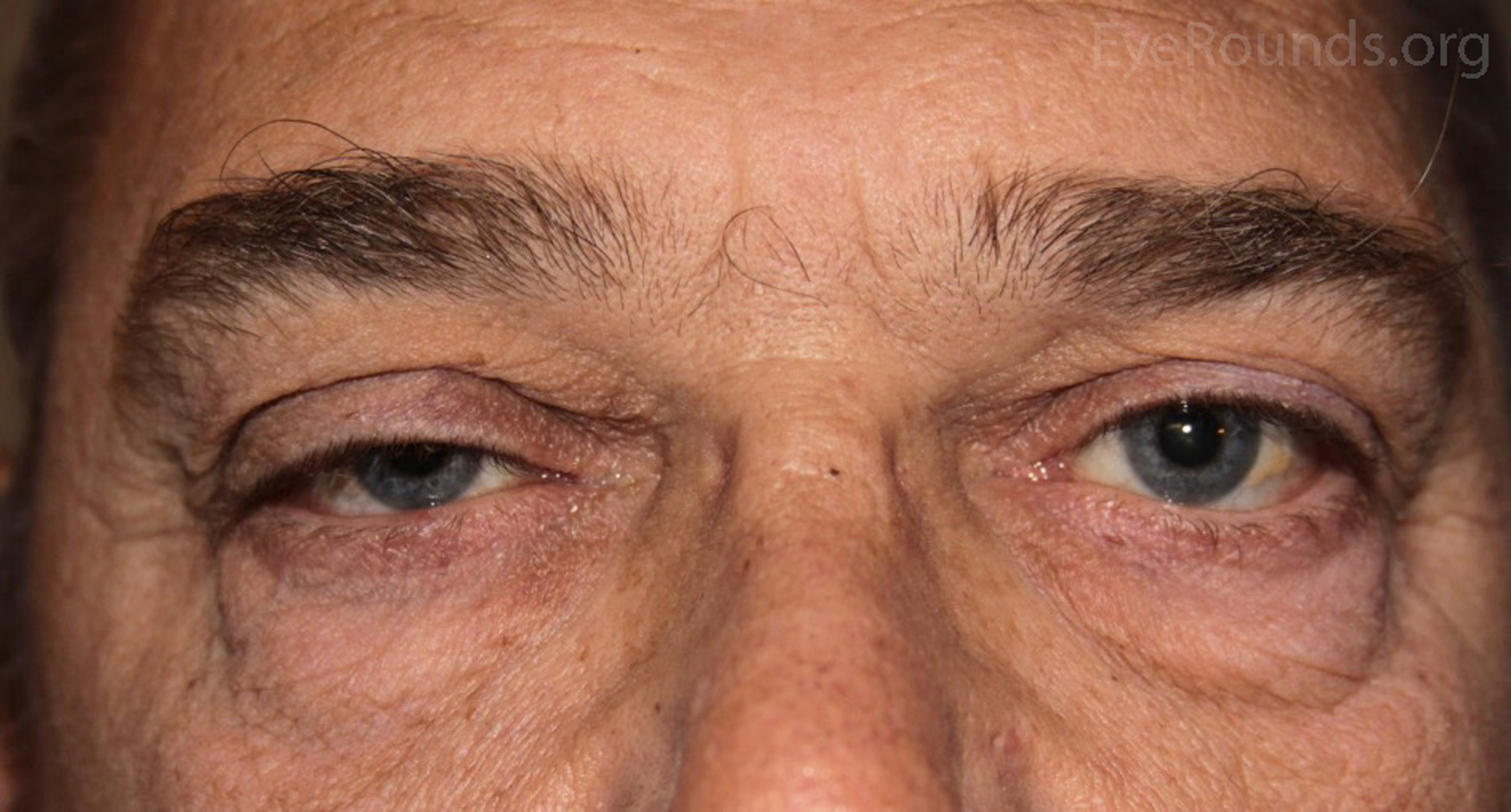 Floppy Eyelid Syndrome