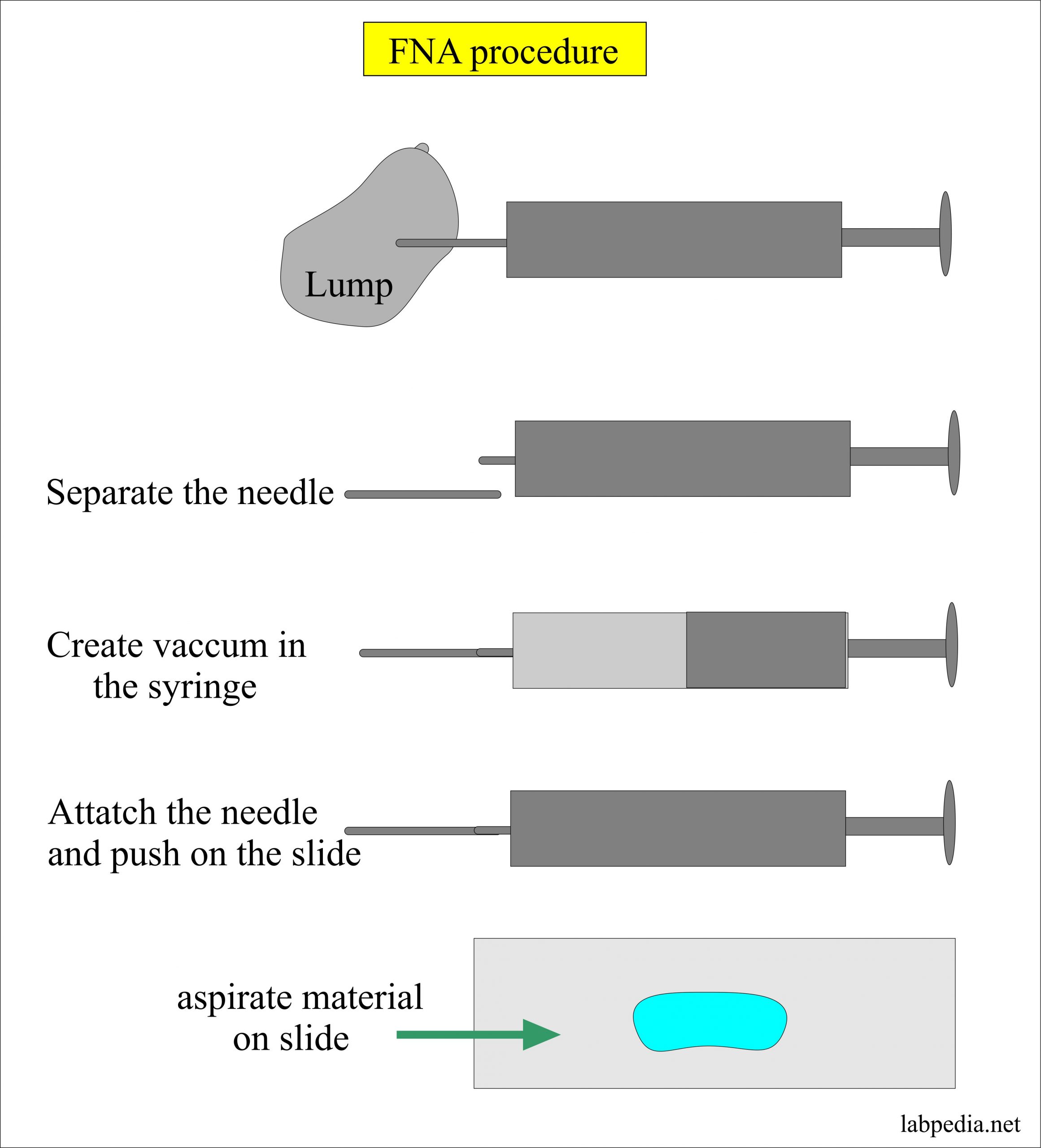 Fna Biopsy Needle