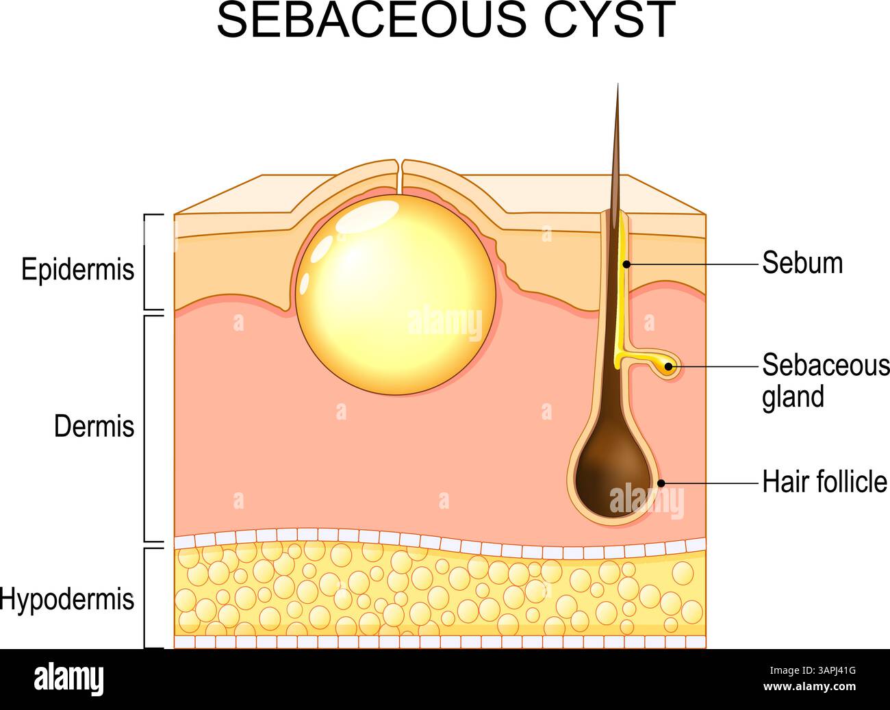 Follicle Or Cyst