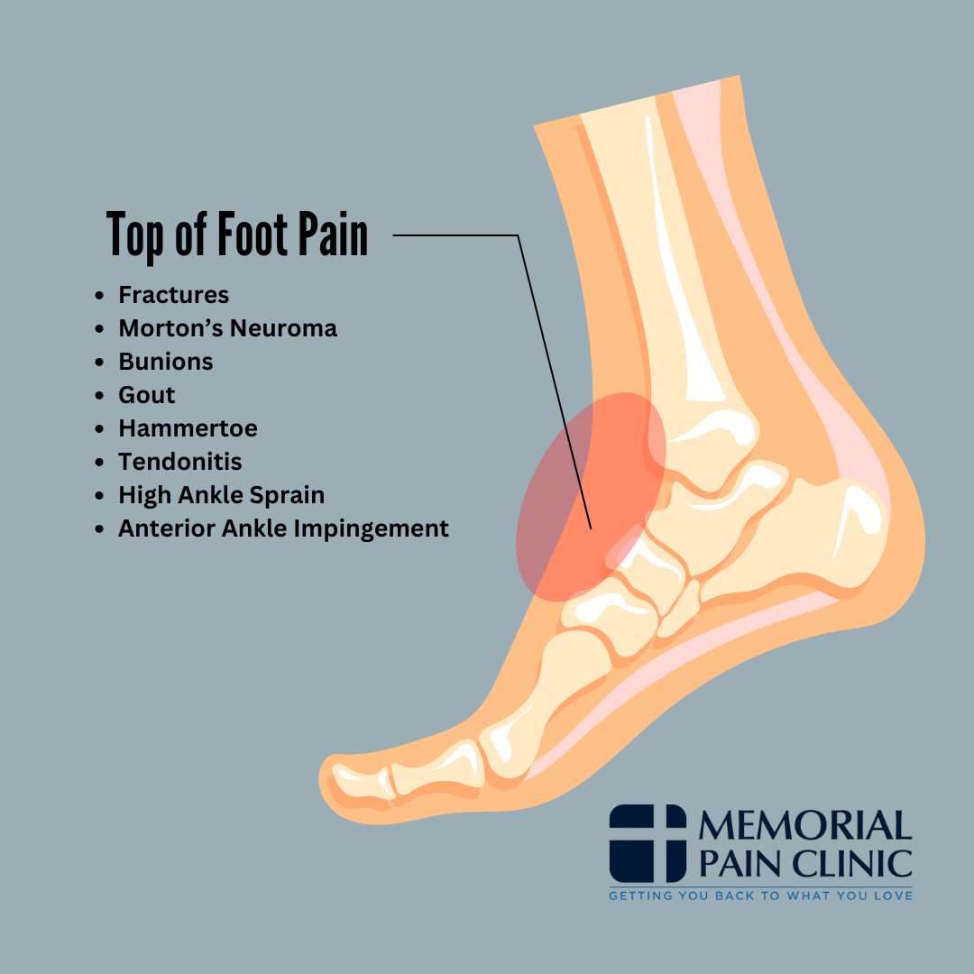 Foot Pain On Top Of