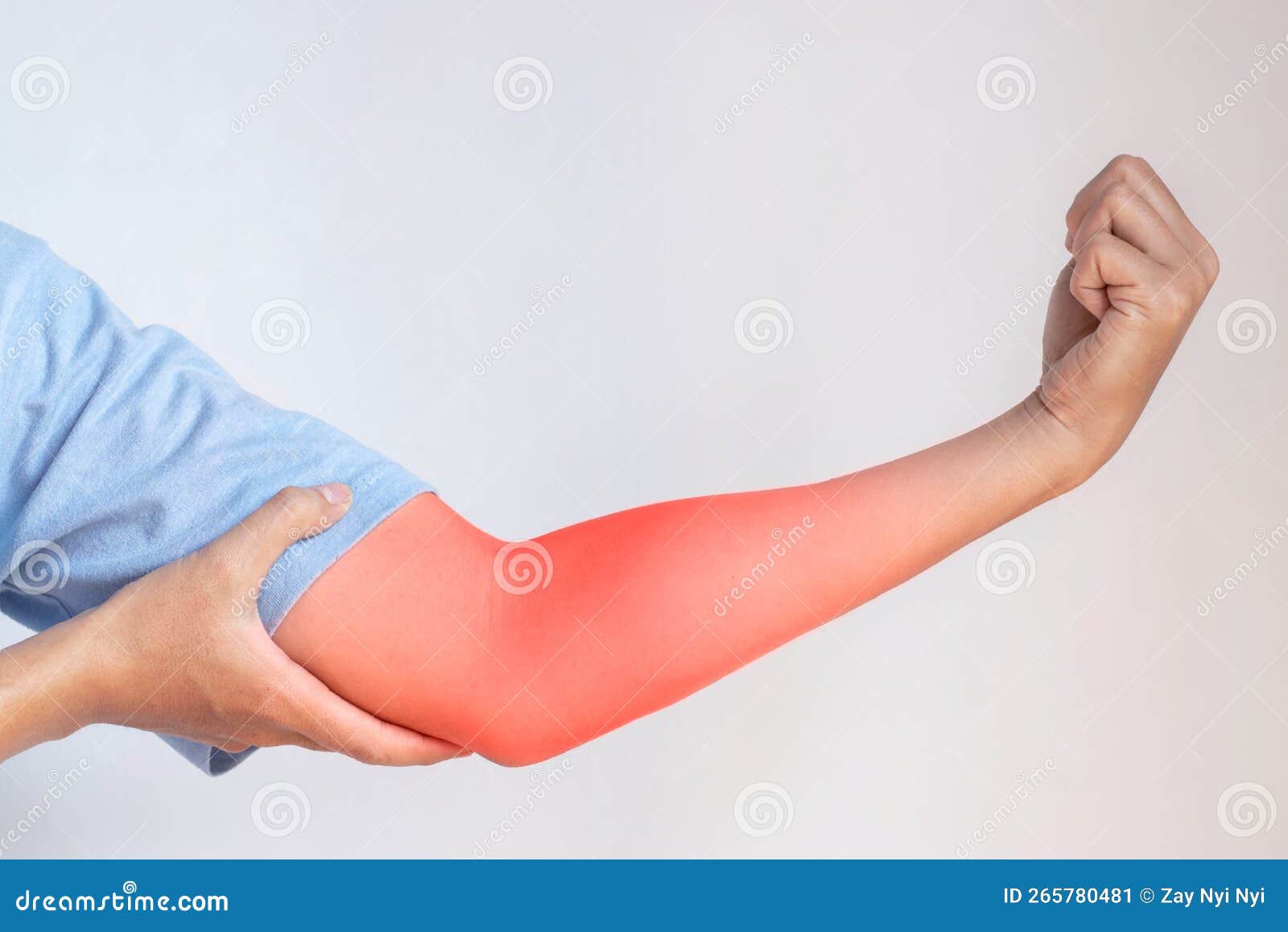 Forearm Muscle Tear