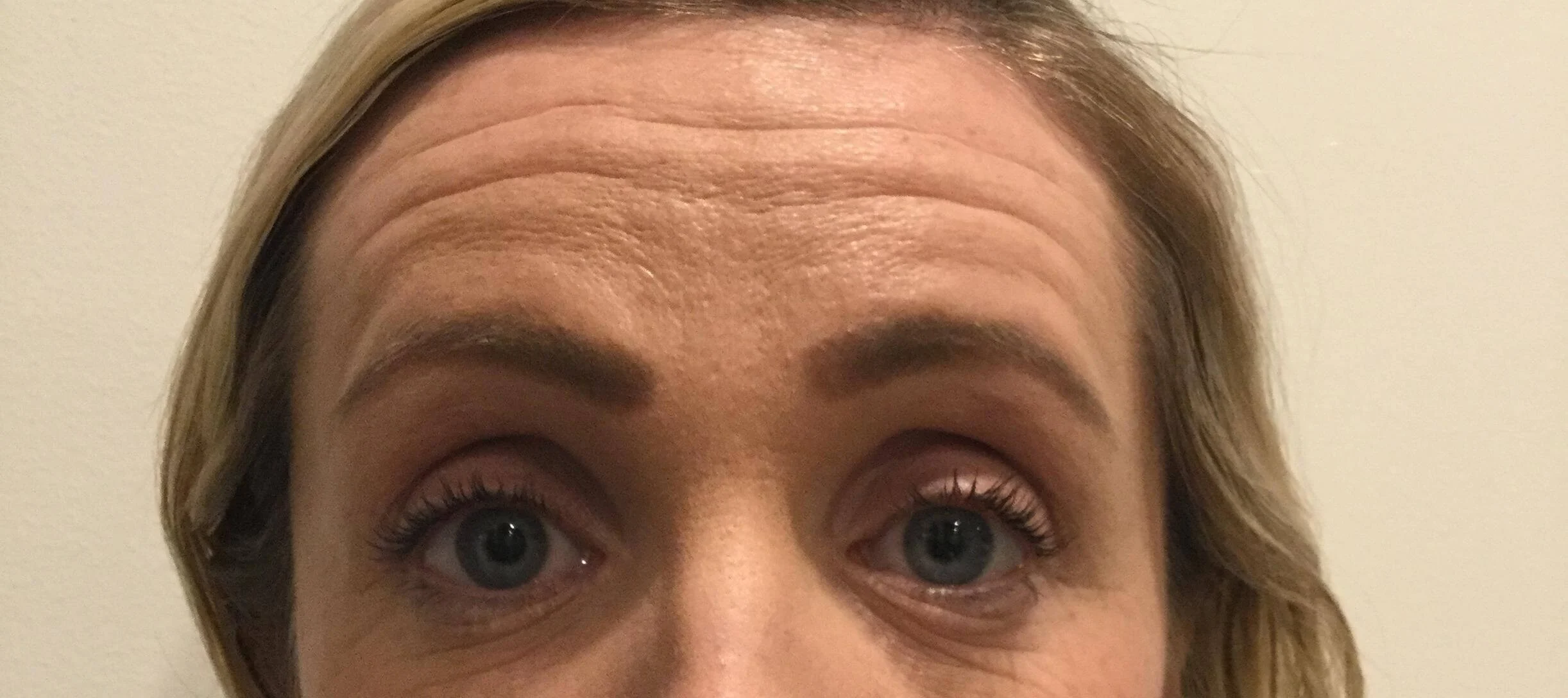 Forehead Lines Botox