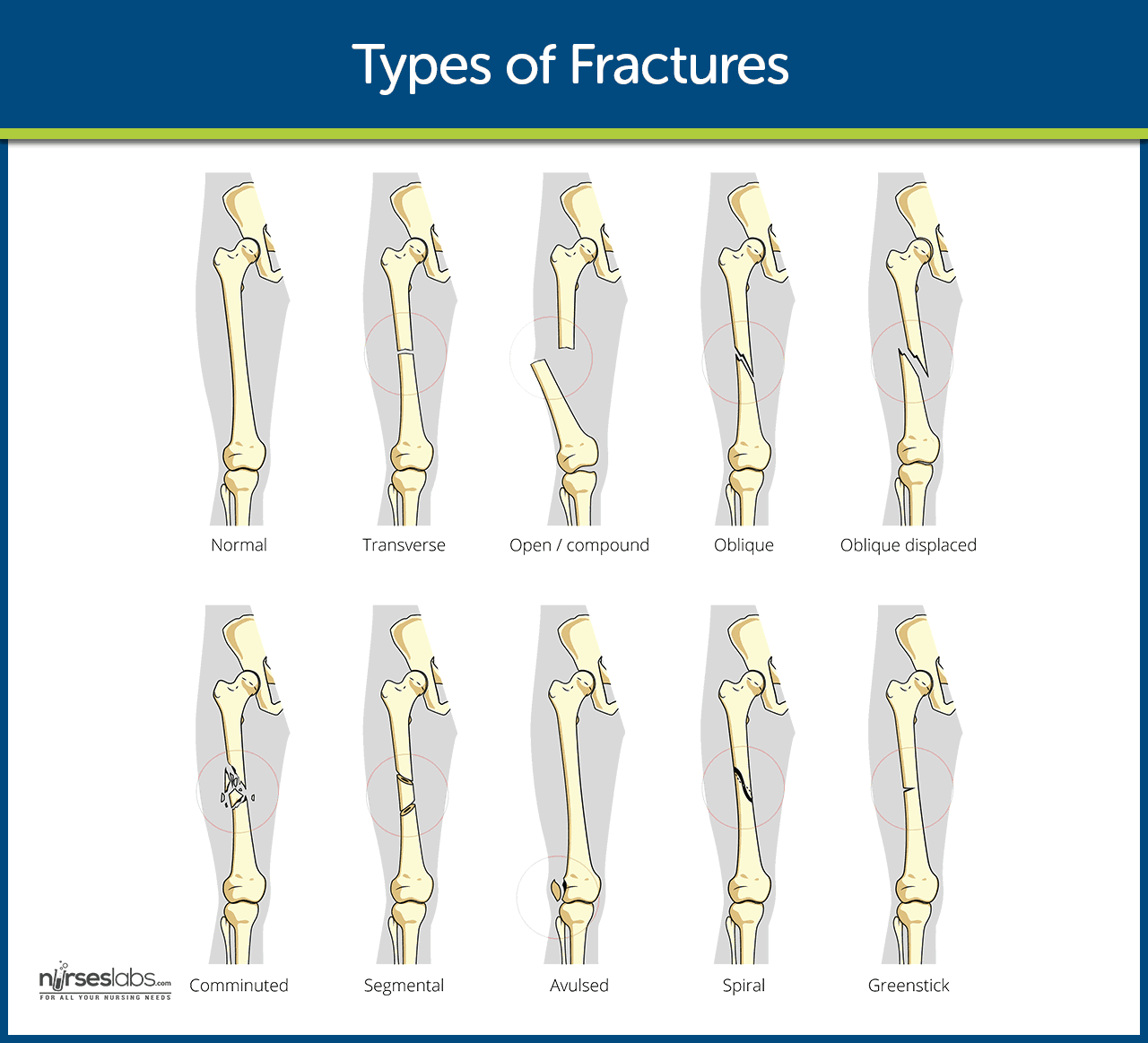 Fracture And Types Of Fracture