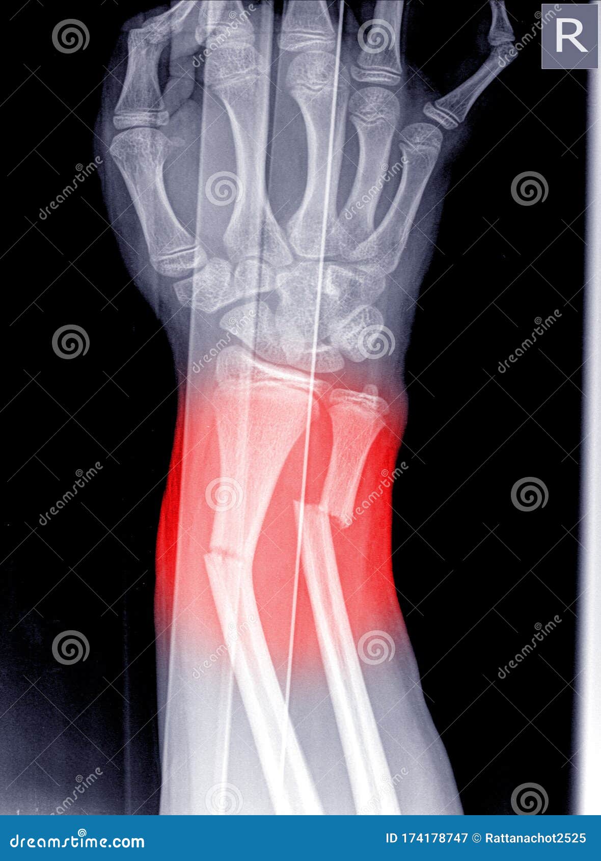 Fracture Broken Wrist
