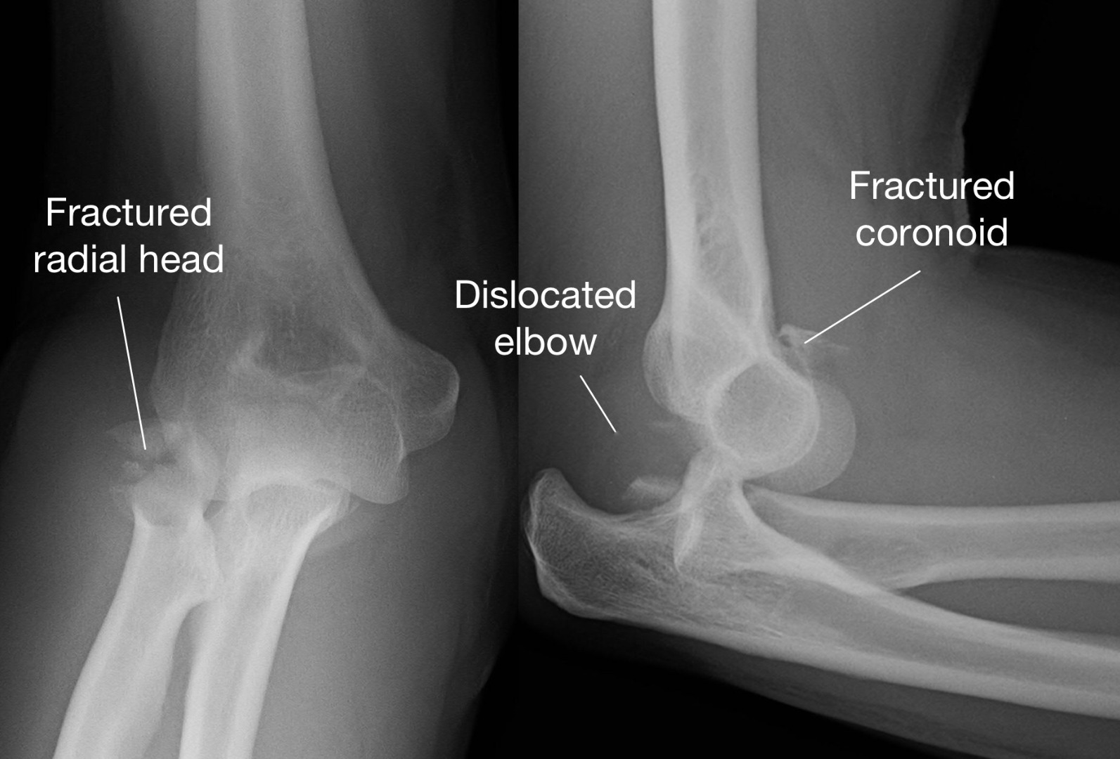Fracture In The Elbow