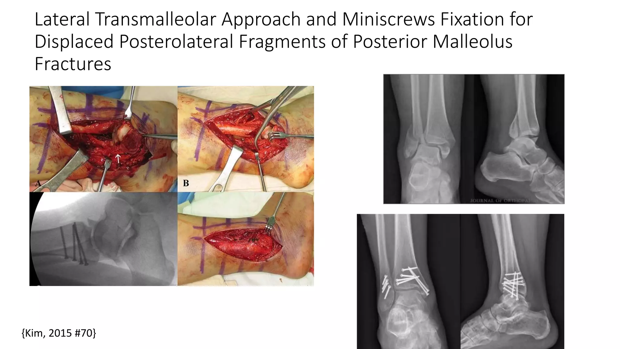 Fracture Of The Posterior Malleolus