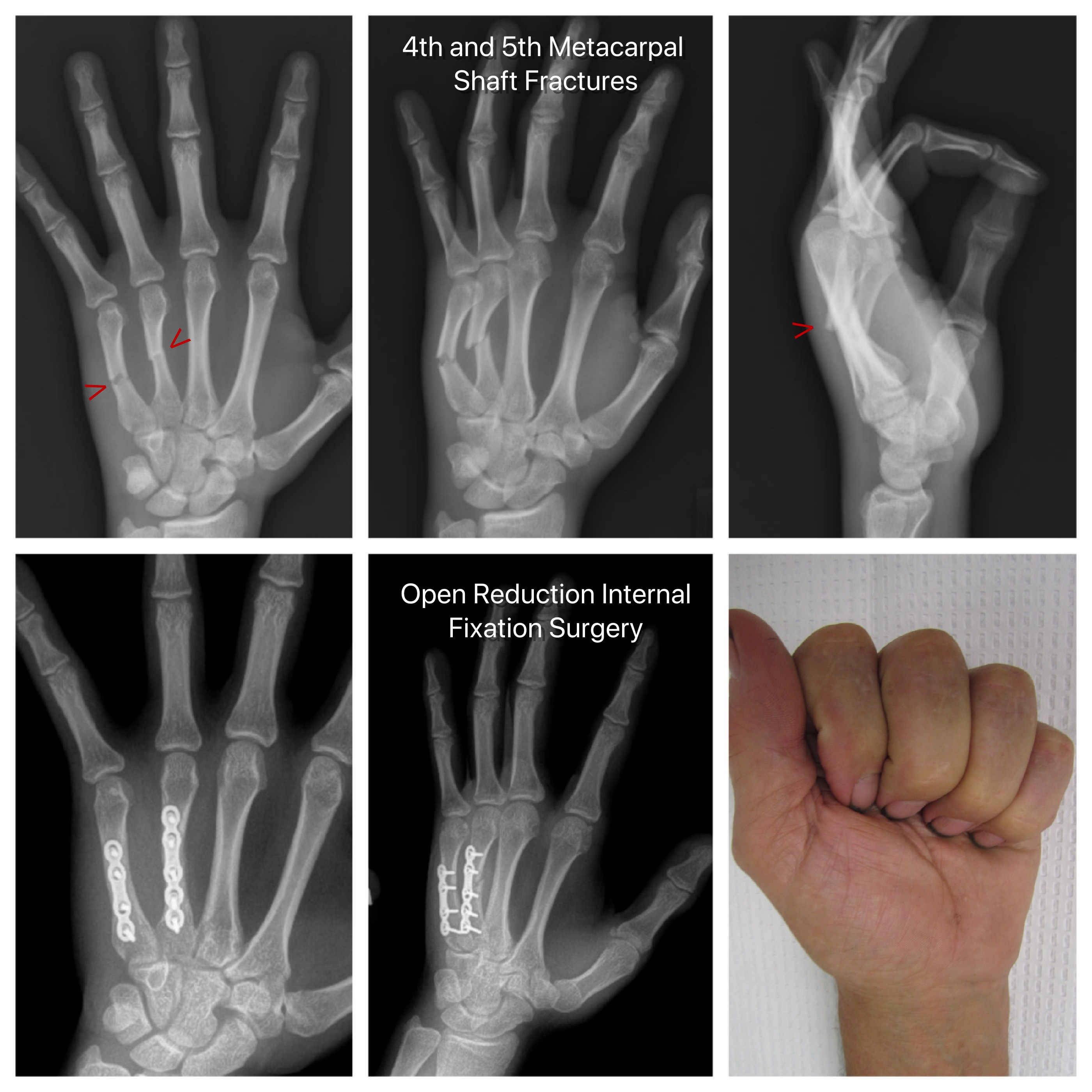 Fractured Finger Recovery Time