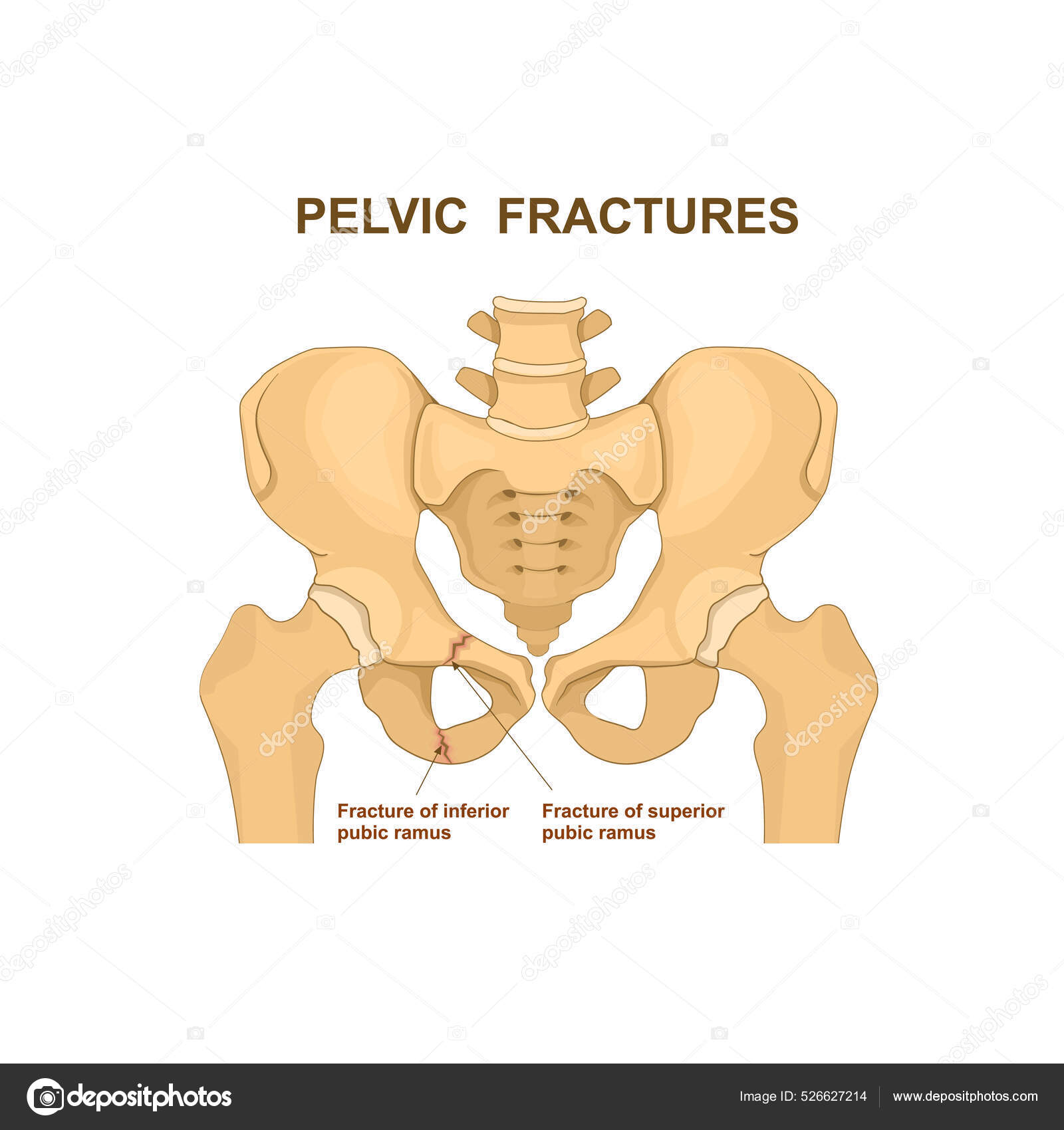 Fractured Inferior Pubic Ramus