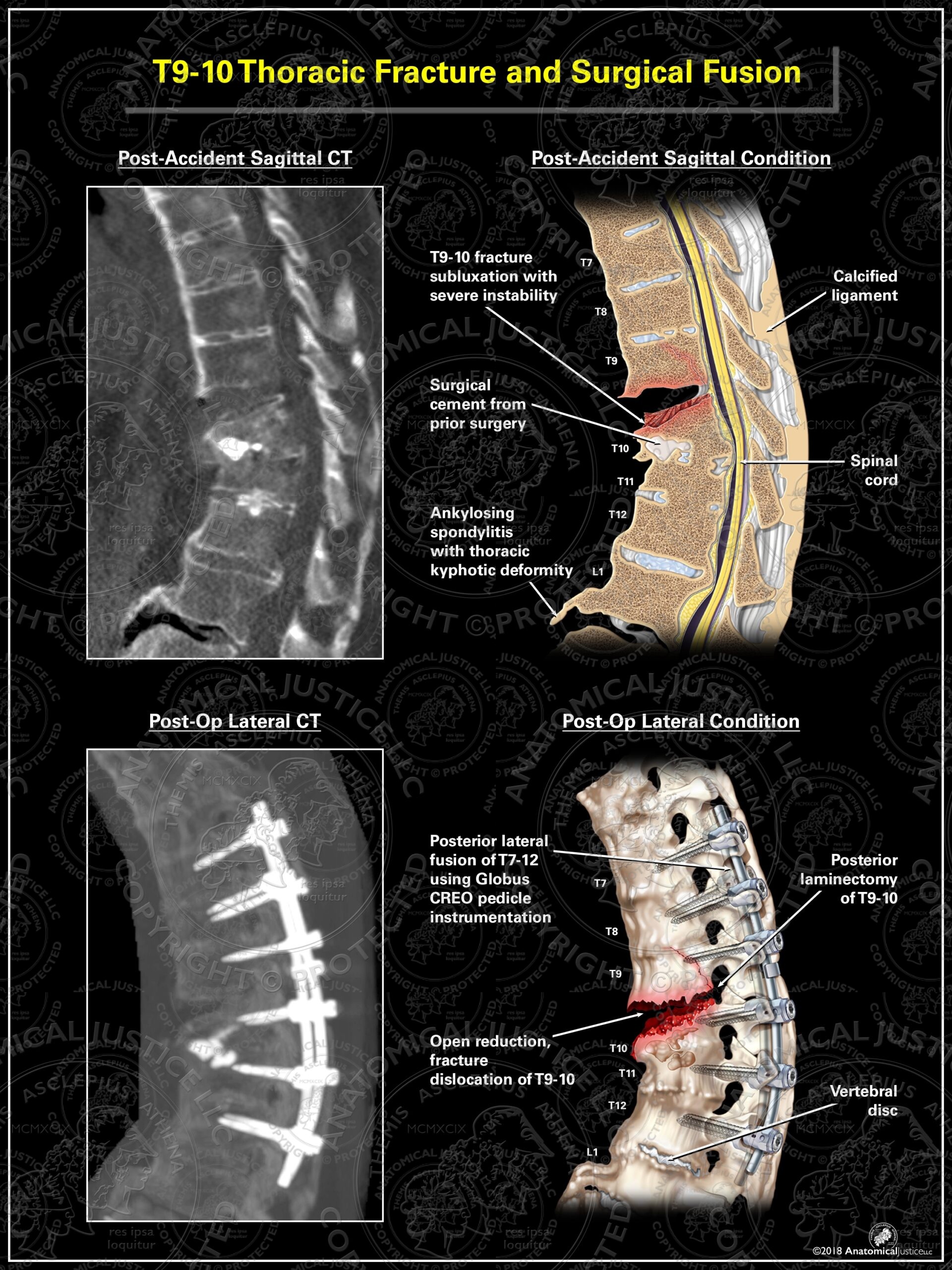Fractured Thoracic Vertebrae