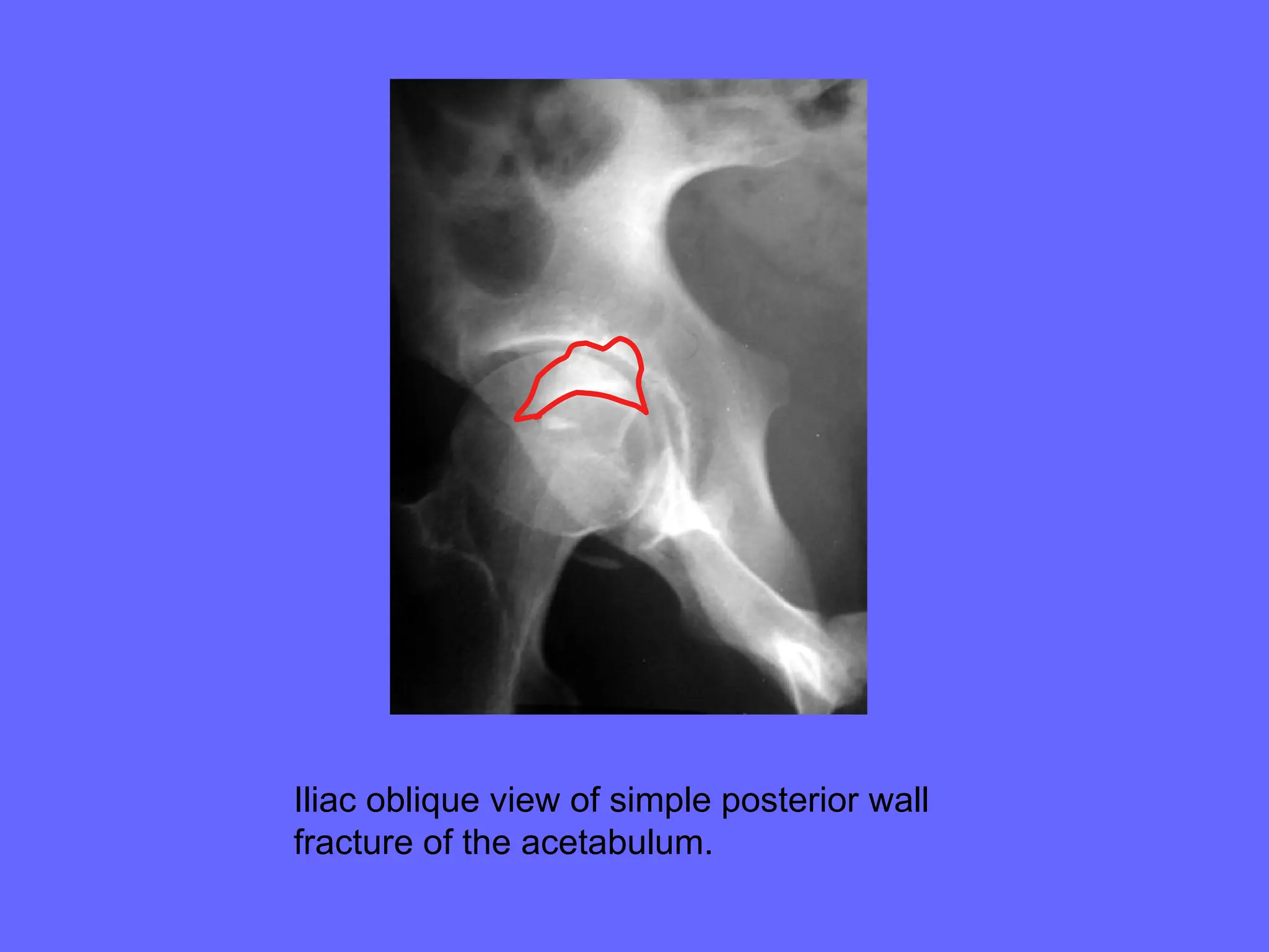 Fractures Of Acetabulum