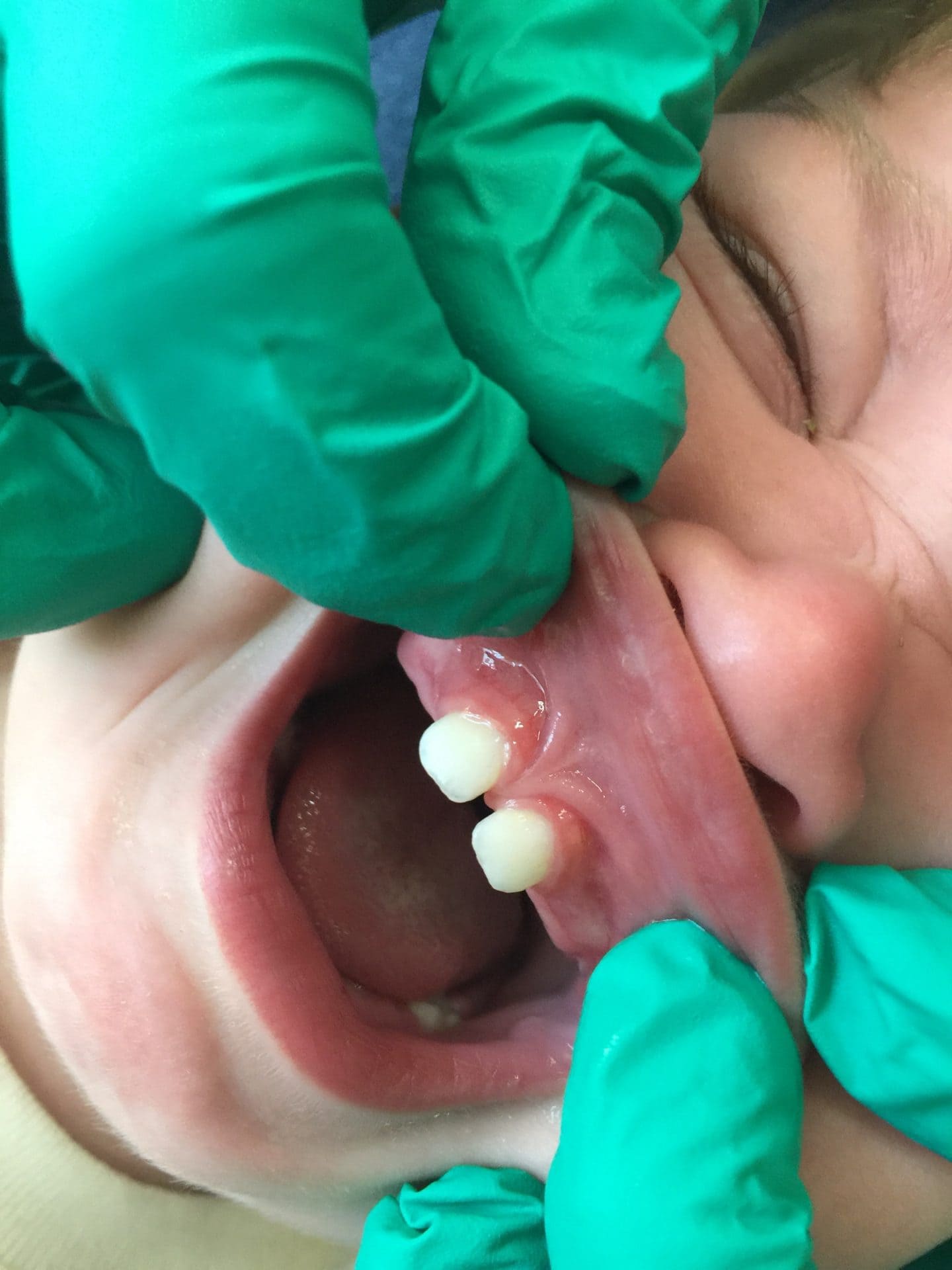Frenectomy For Lip Tie