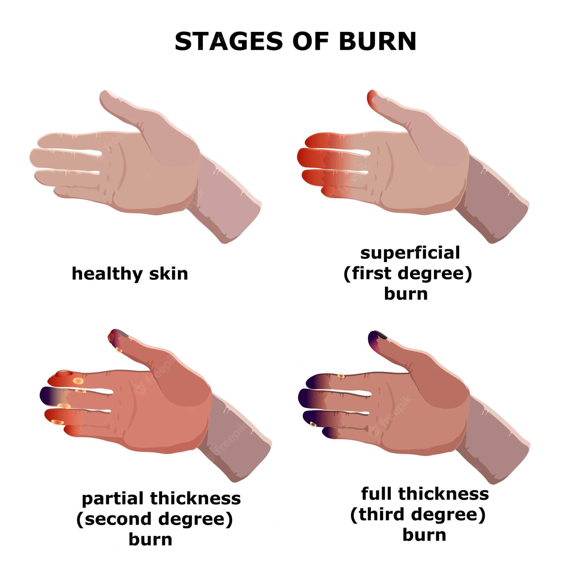 Friction Burn Healing Stages