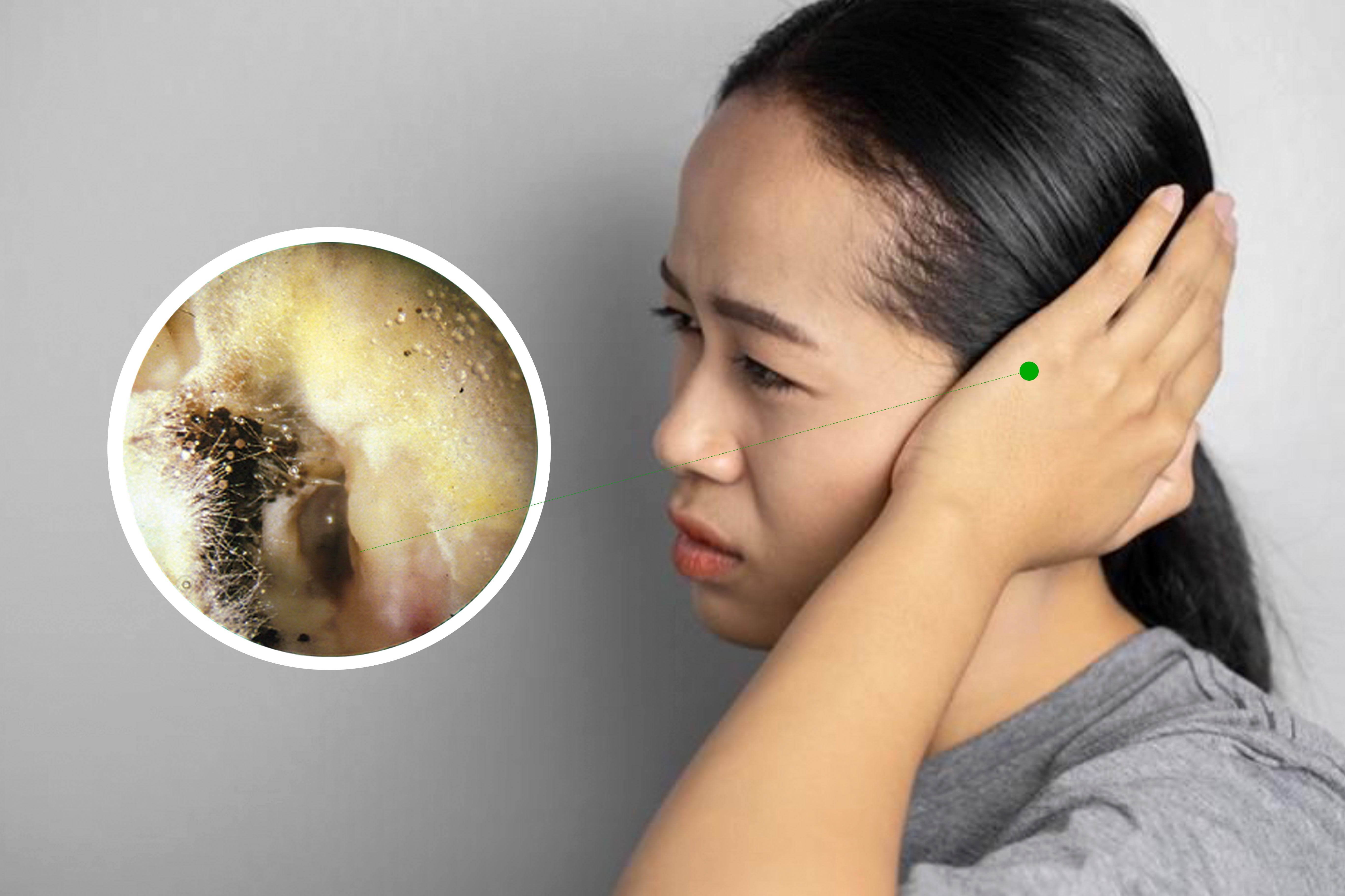 Fungal Infection In Ears Pictures