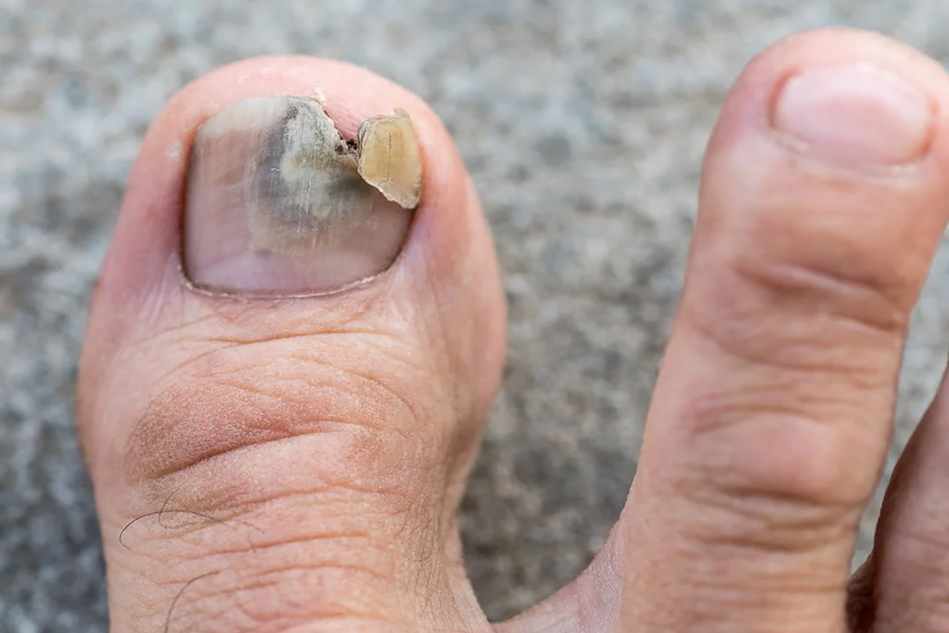 Fungus On Nail Toe