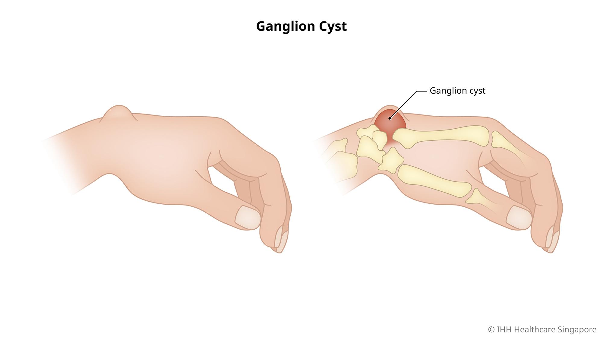 G Cyst Hand