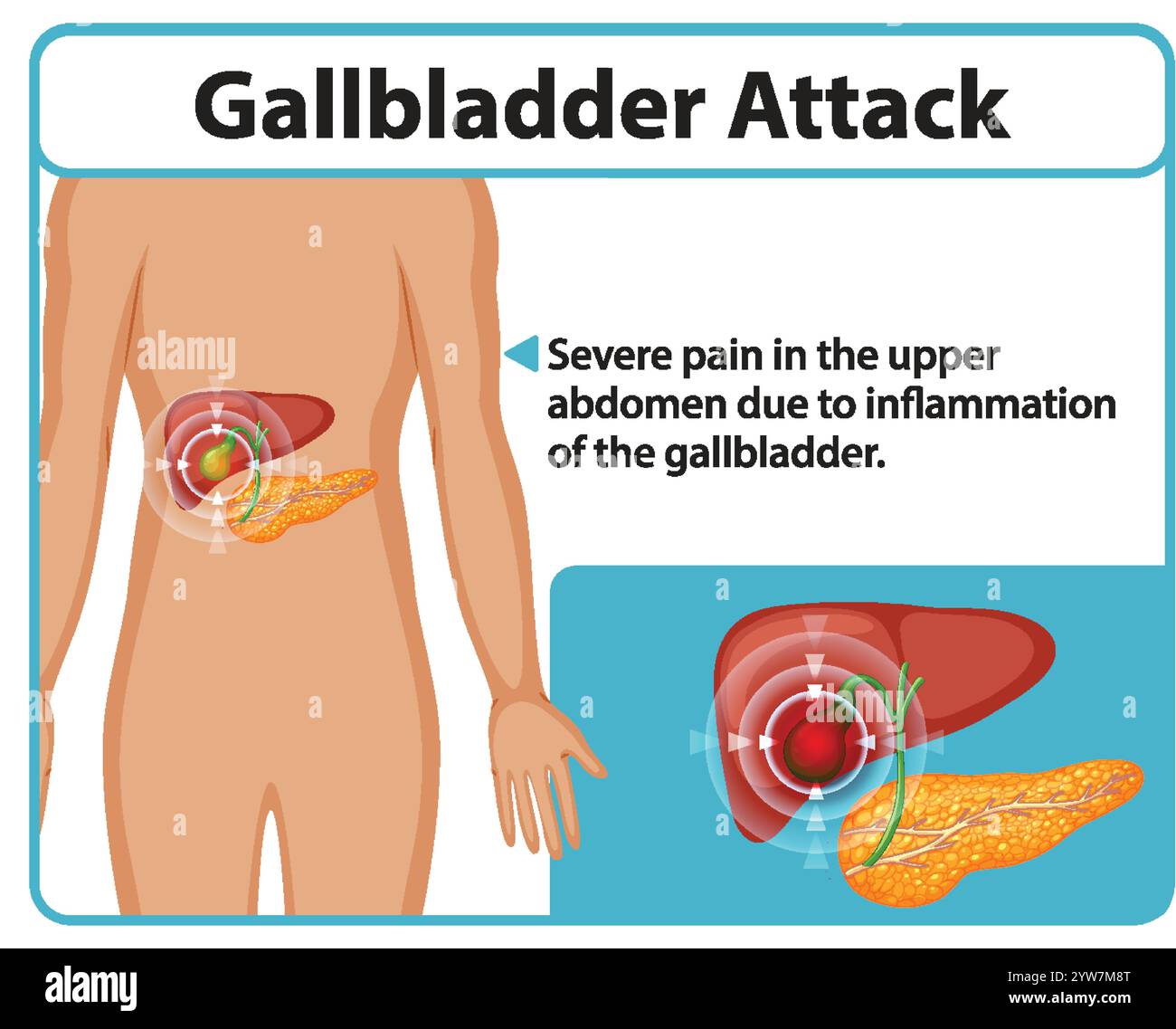 Gall Bladder Attack Symptoms