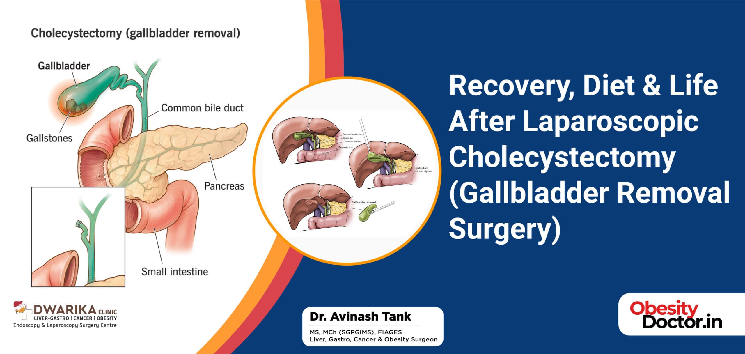 Gall Surgery Recovery