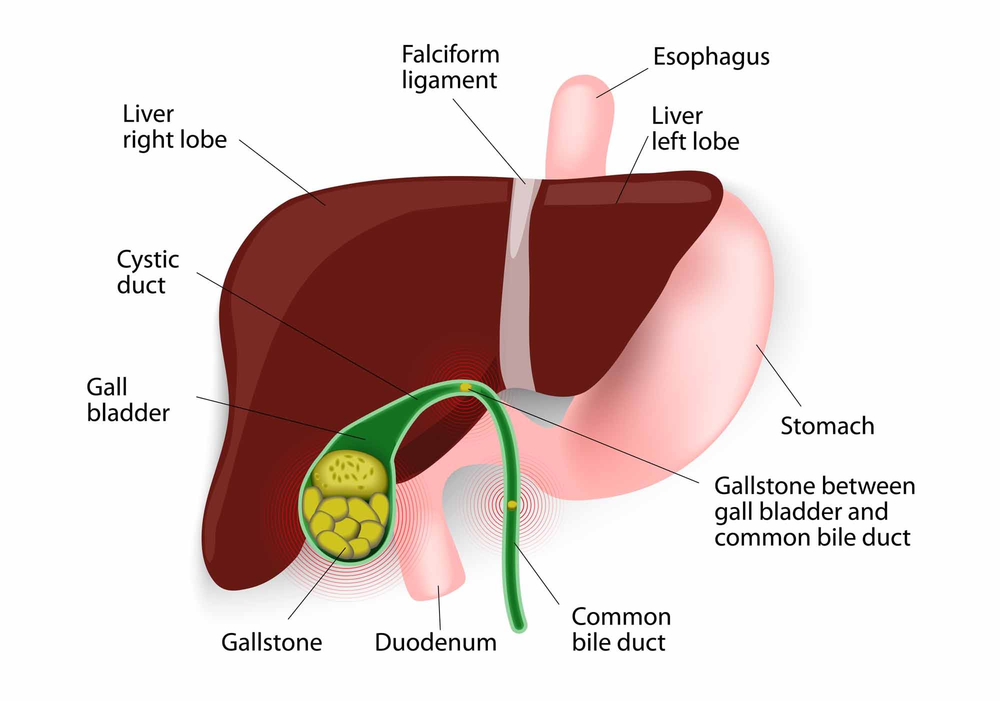 Gallbladder Gallstones In Spanish