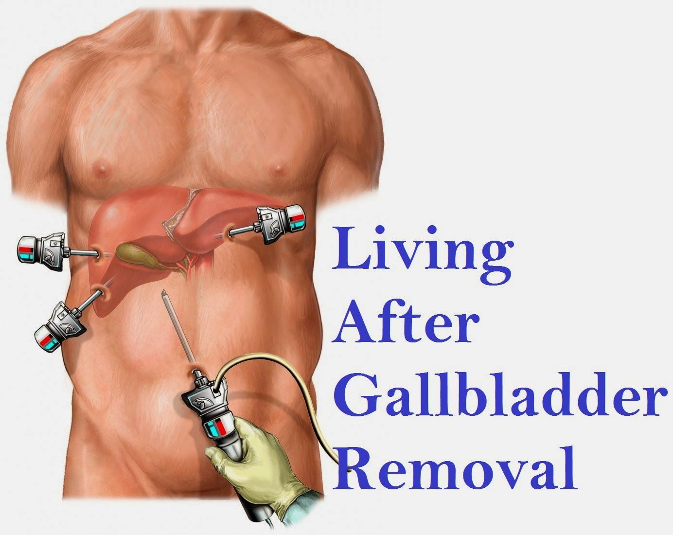 Gallbladder Removal Recovery Time