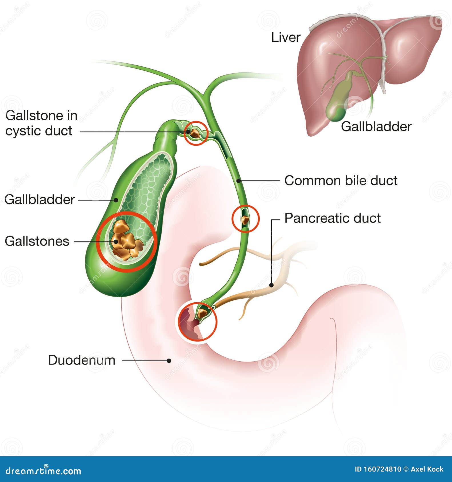 Gallbladder Stones Pictures