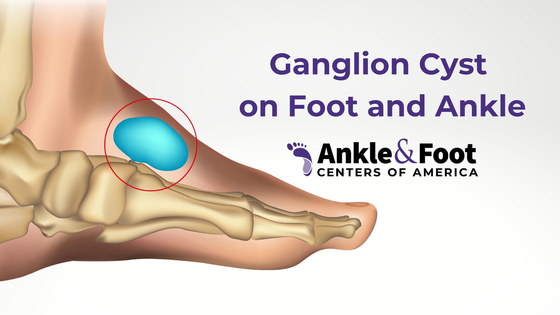 Ganglion Cyst On Foot