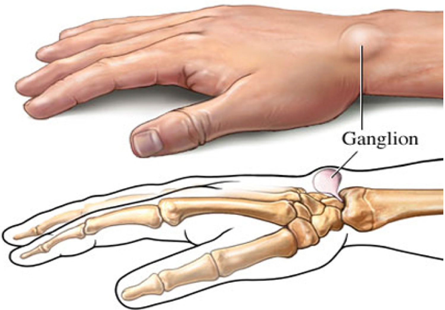 Ganglion Cyst Palm Of Hand