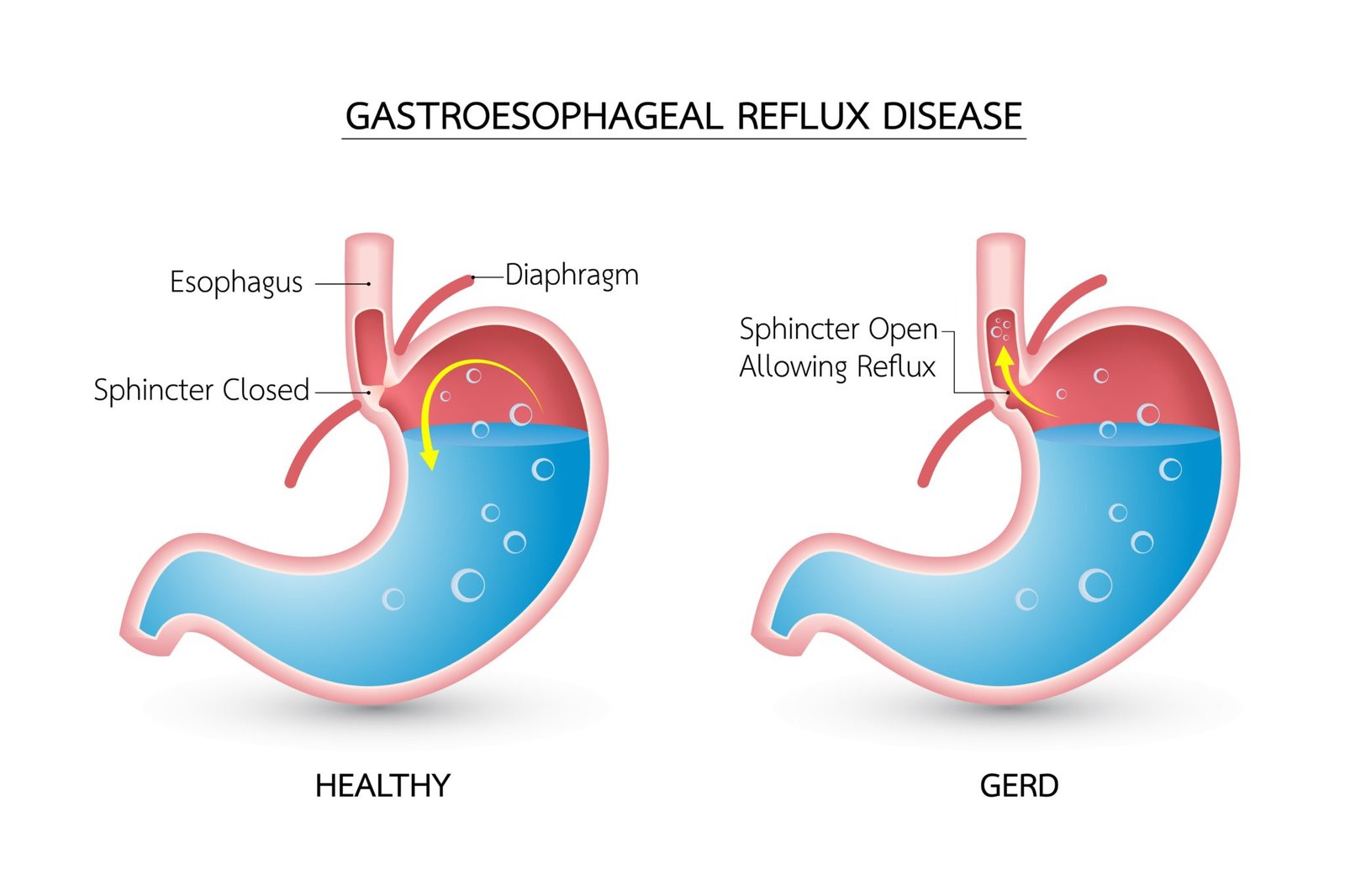 Gastroesophageal Reflux Disease Doctors
