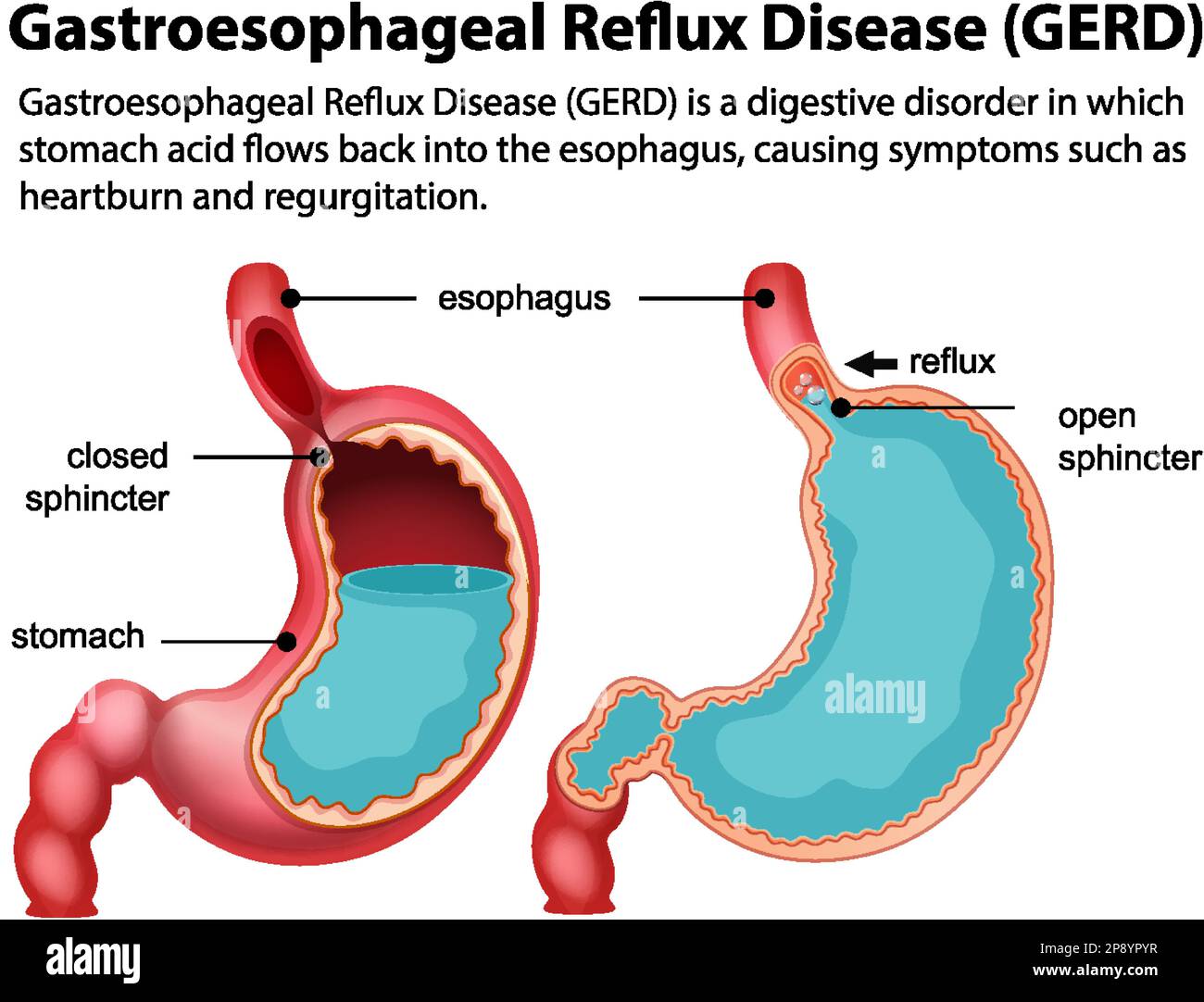 Gastroesophageal Reflux Hiccups