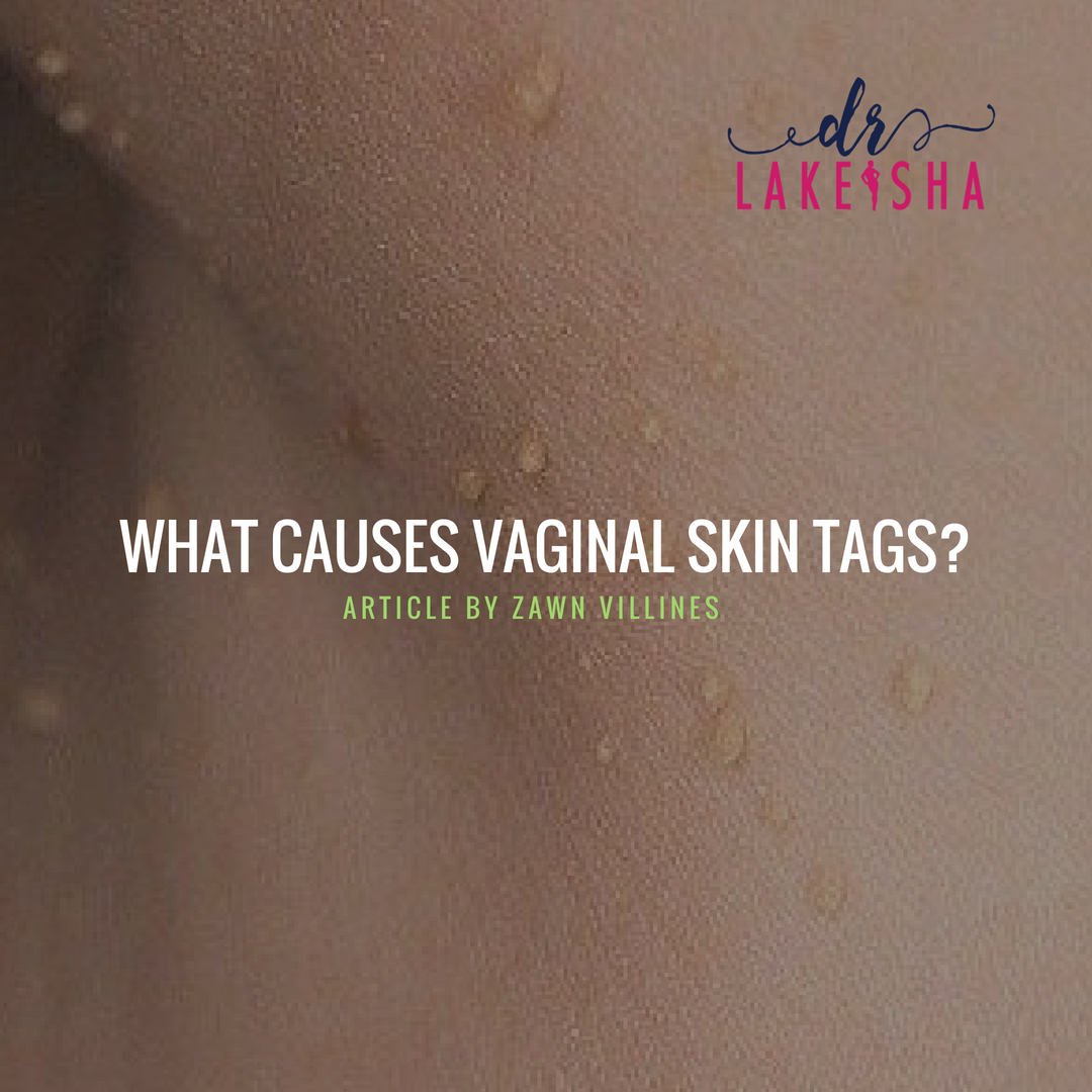 Genital Skin Tags