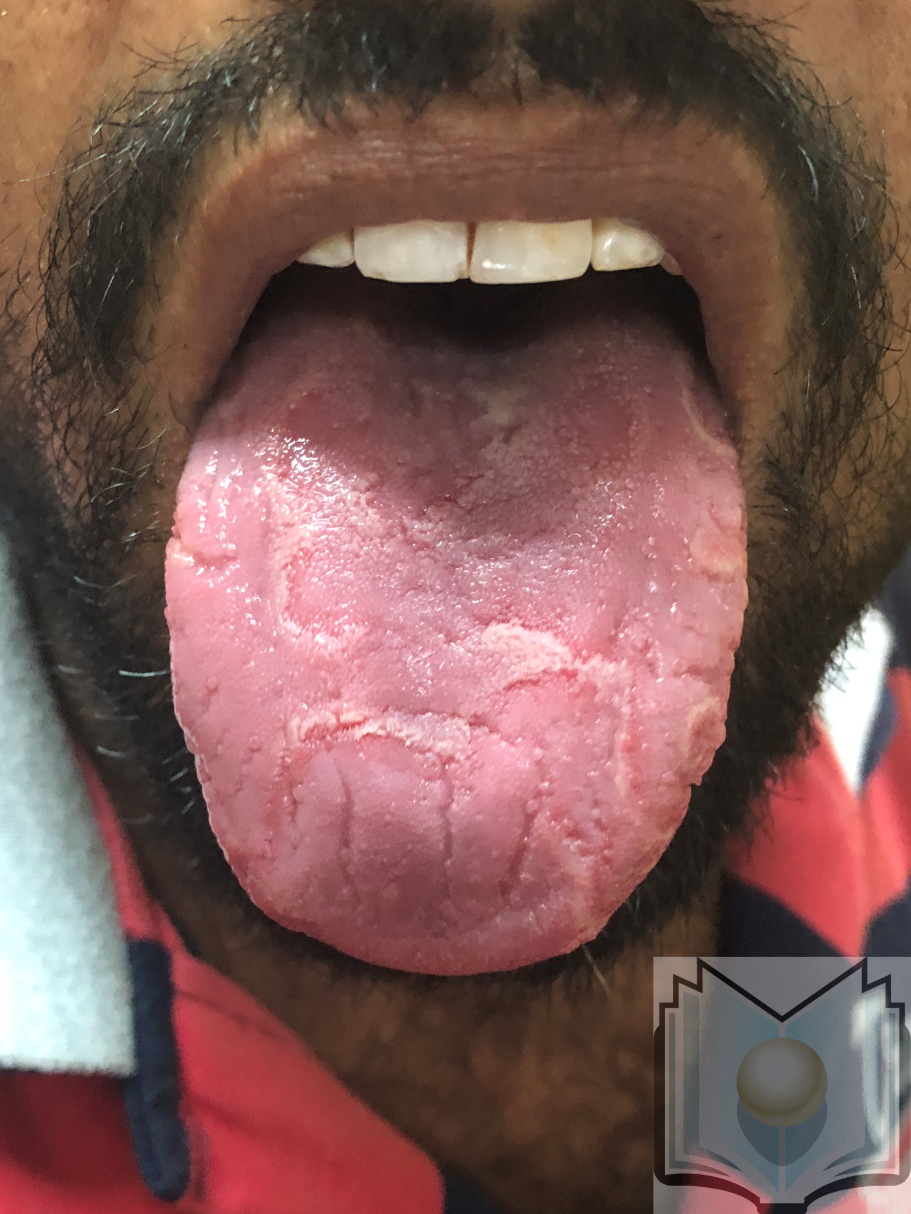 Geographic Tongue Treatment