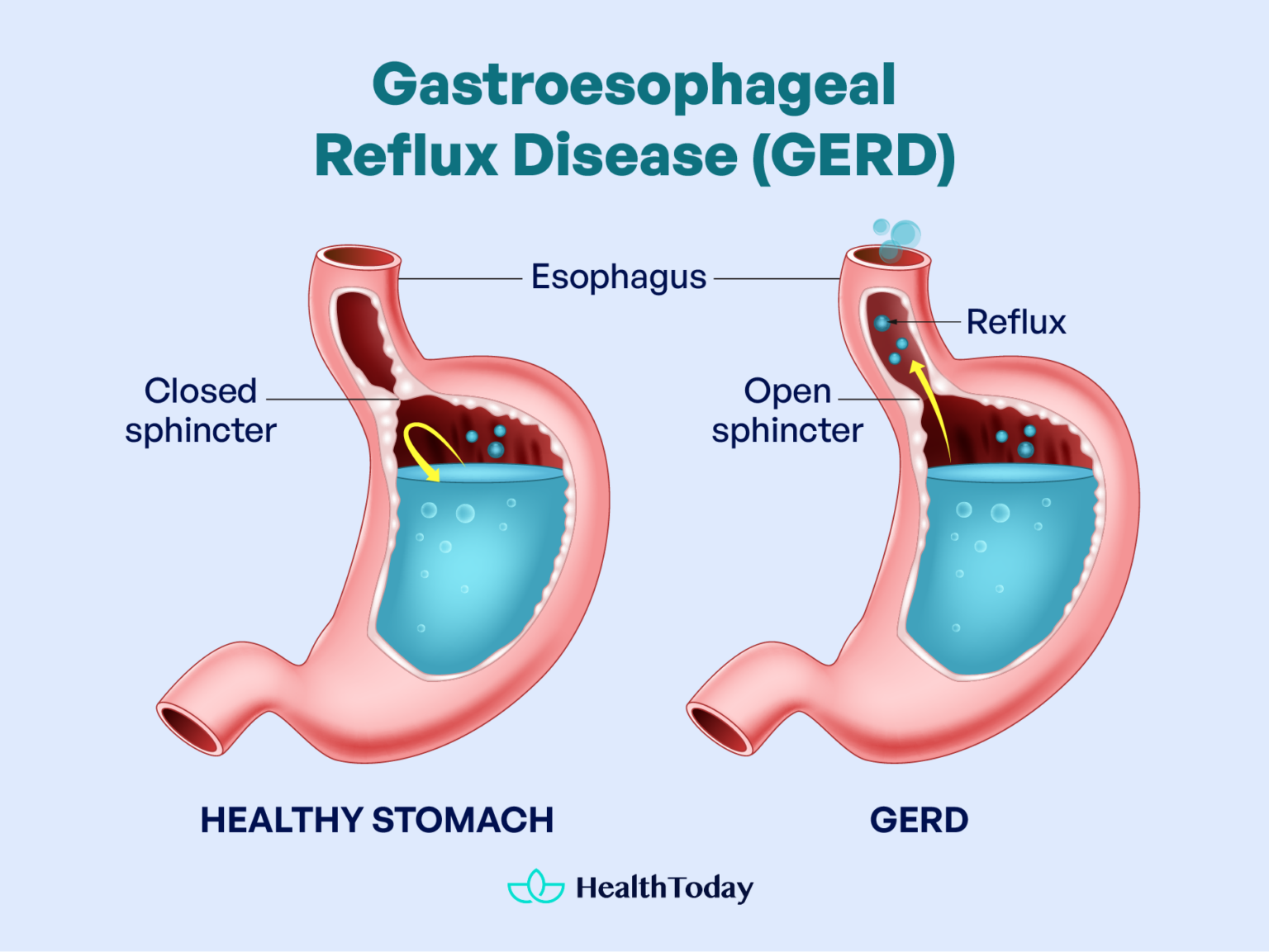 Gerd Symptoms At Night