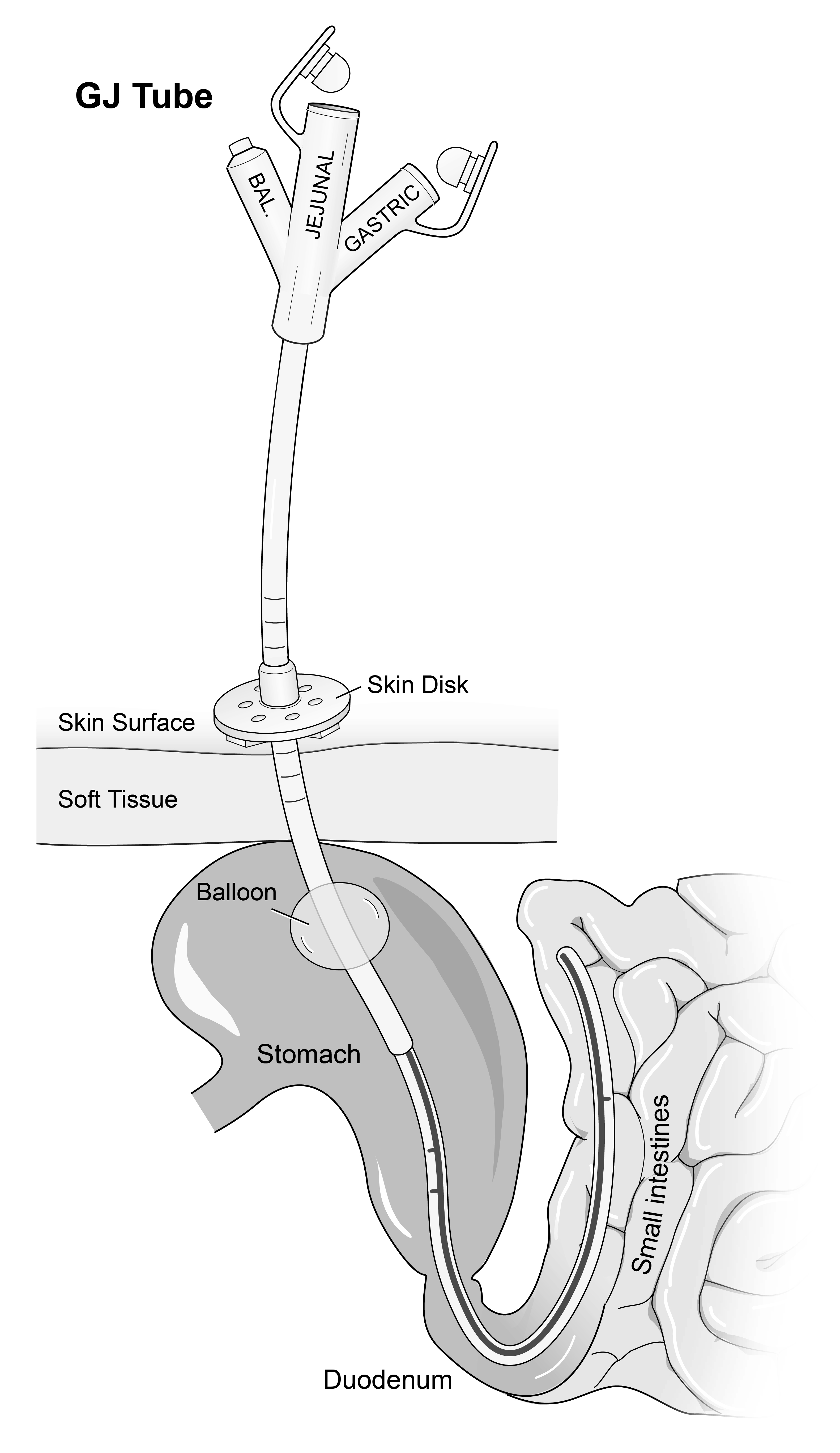 Gj Tube Vs J Tube
