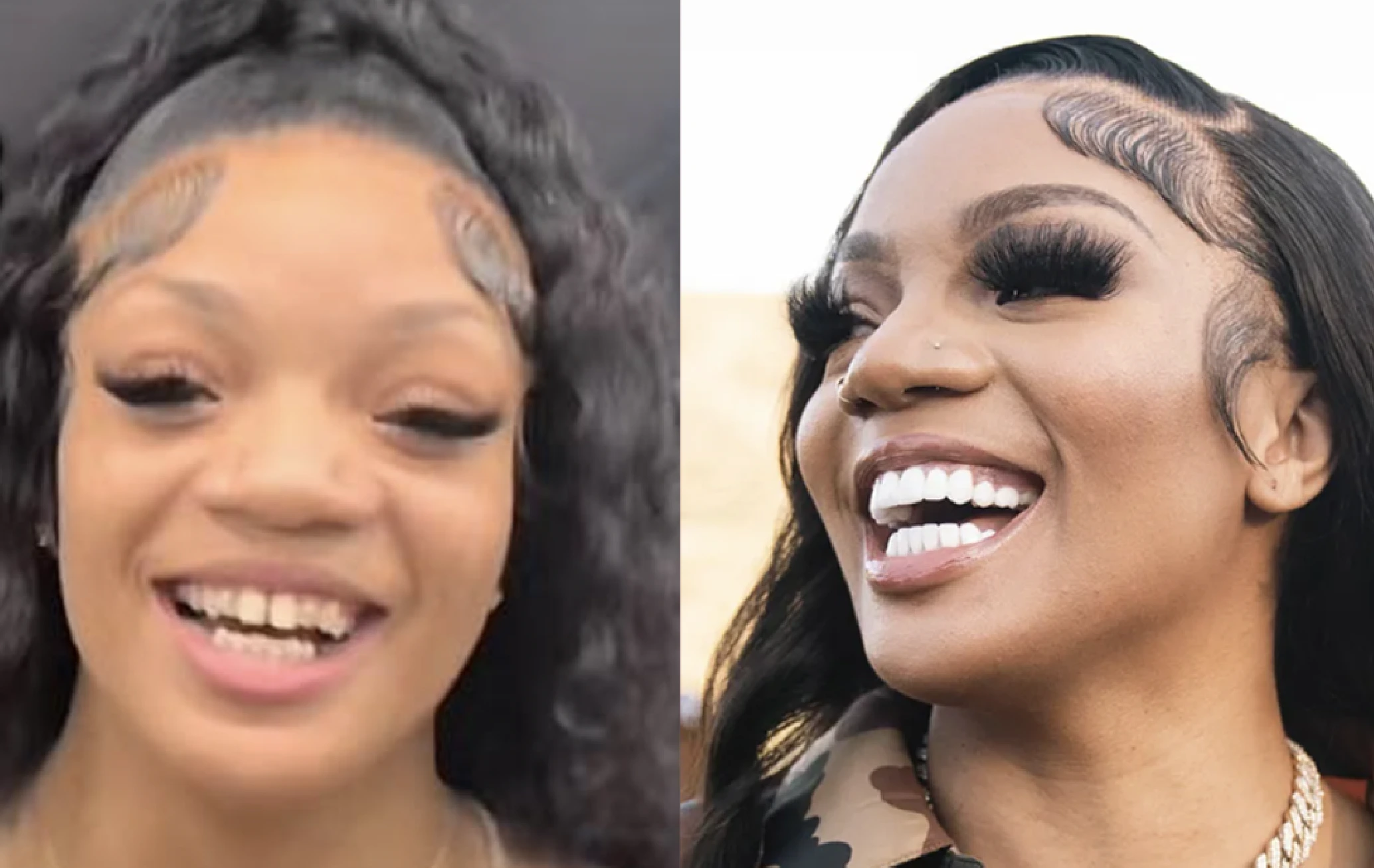 Glorilla Face Surgery